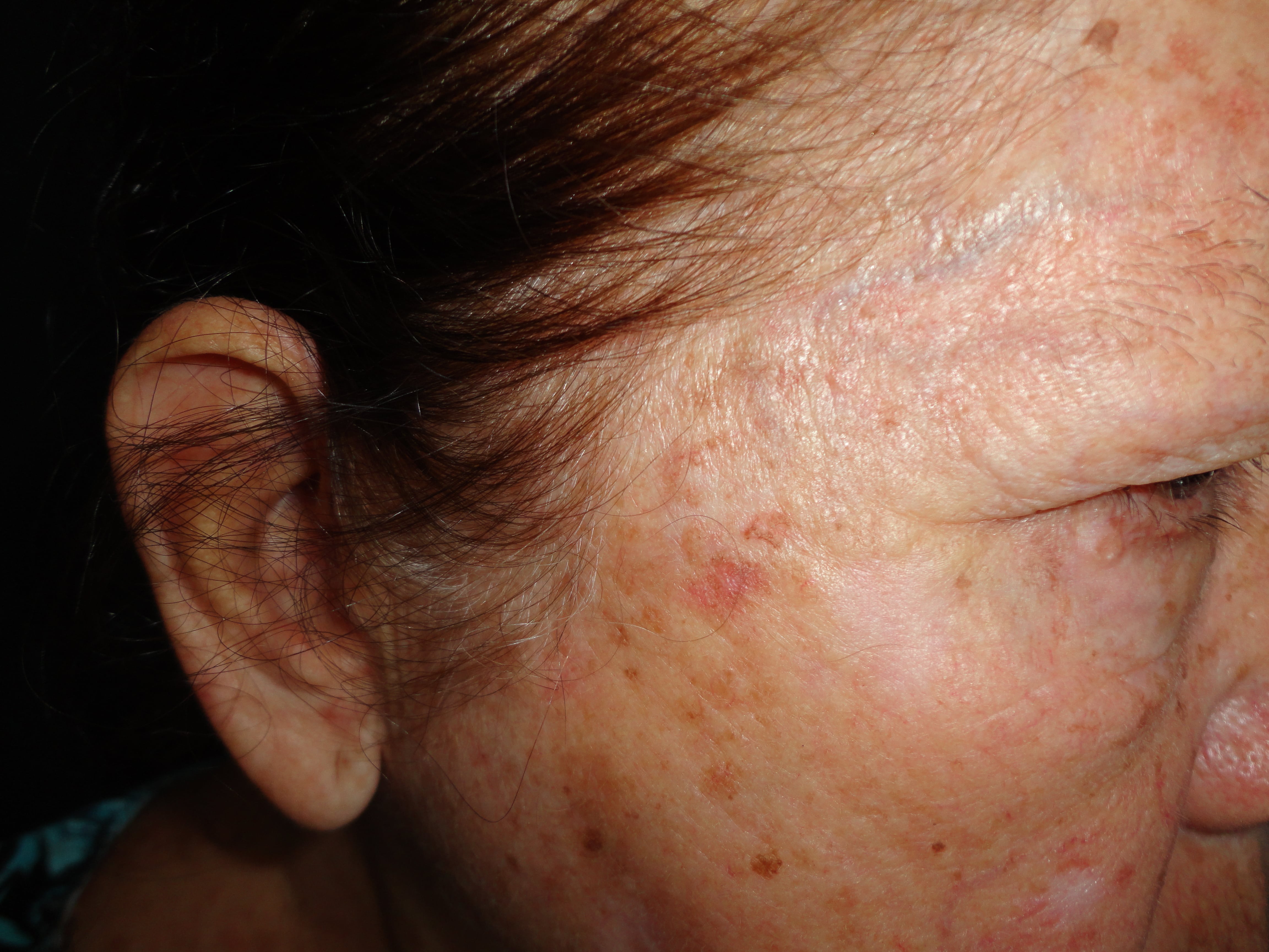 QIUERATOSIS ACTINICA