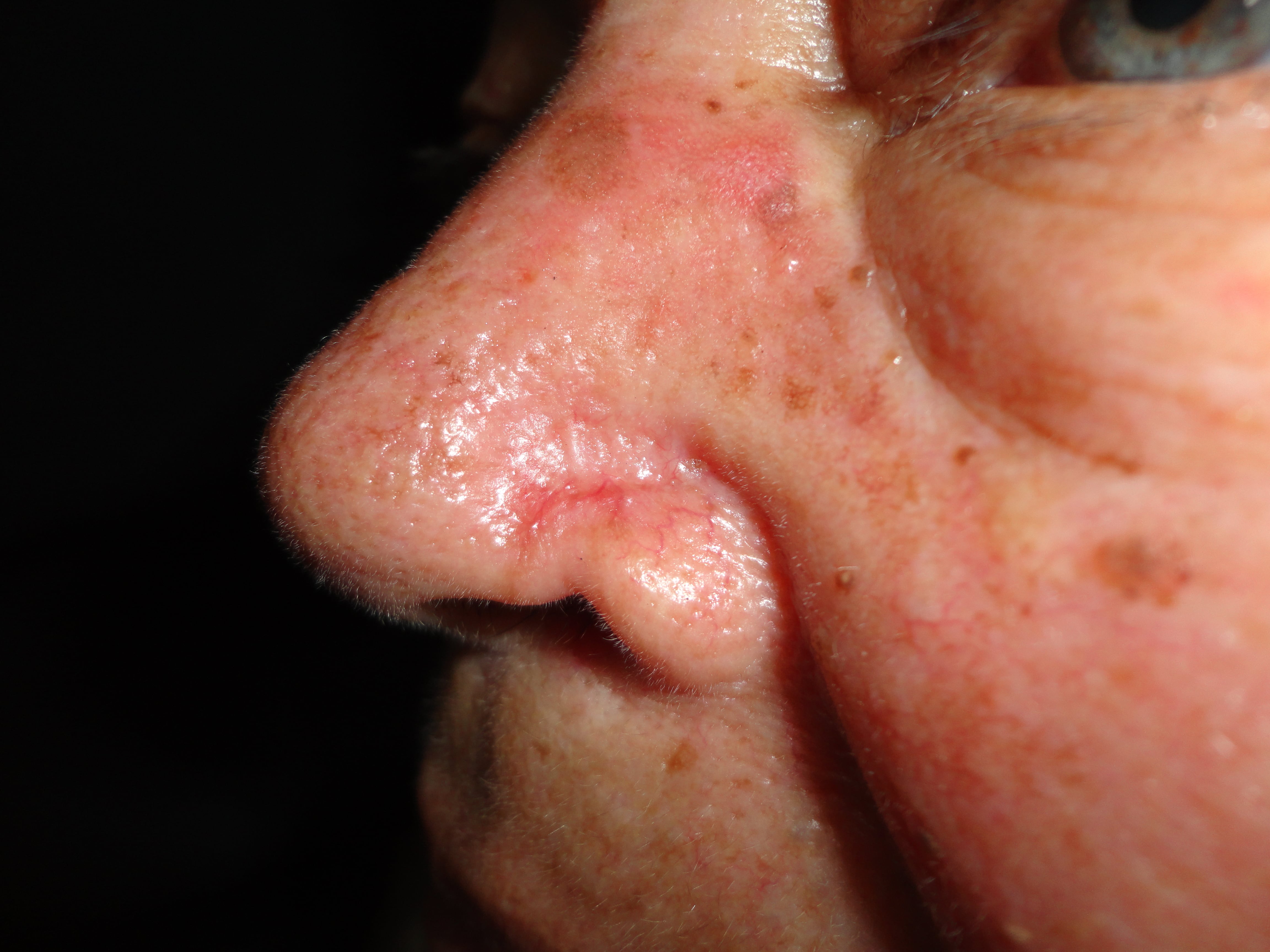 QIUERATOSIS ACTINICA