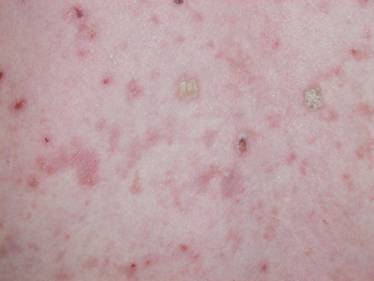 QIUERATOSIS ACTINICA - Albinismo