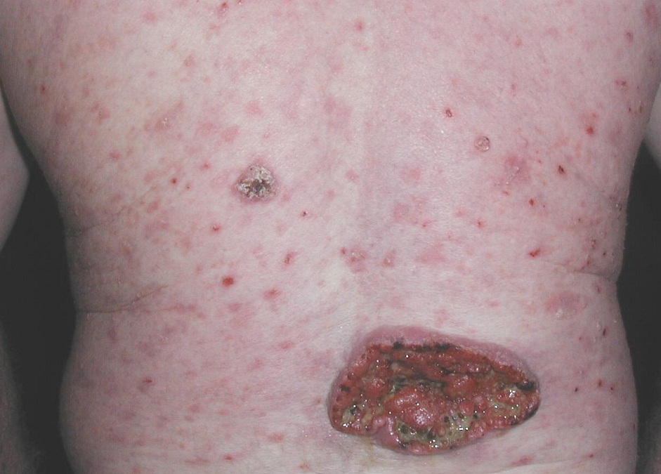 QIUERATOSIS ACTINICA - Albinismo - Carcinoma Espinocelular
