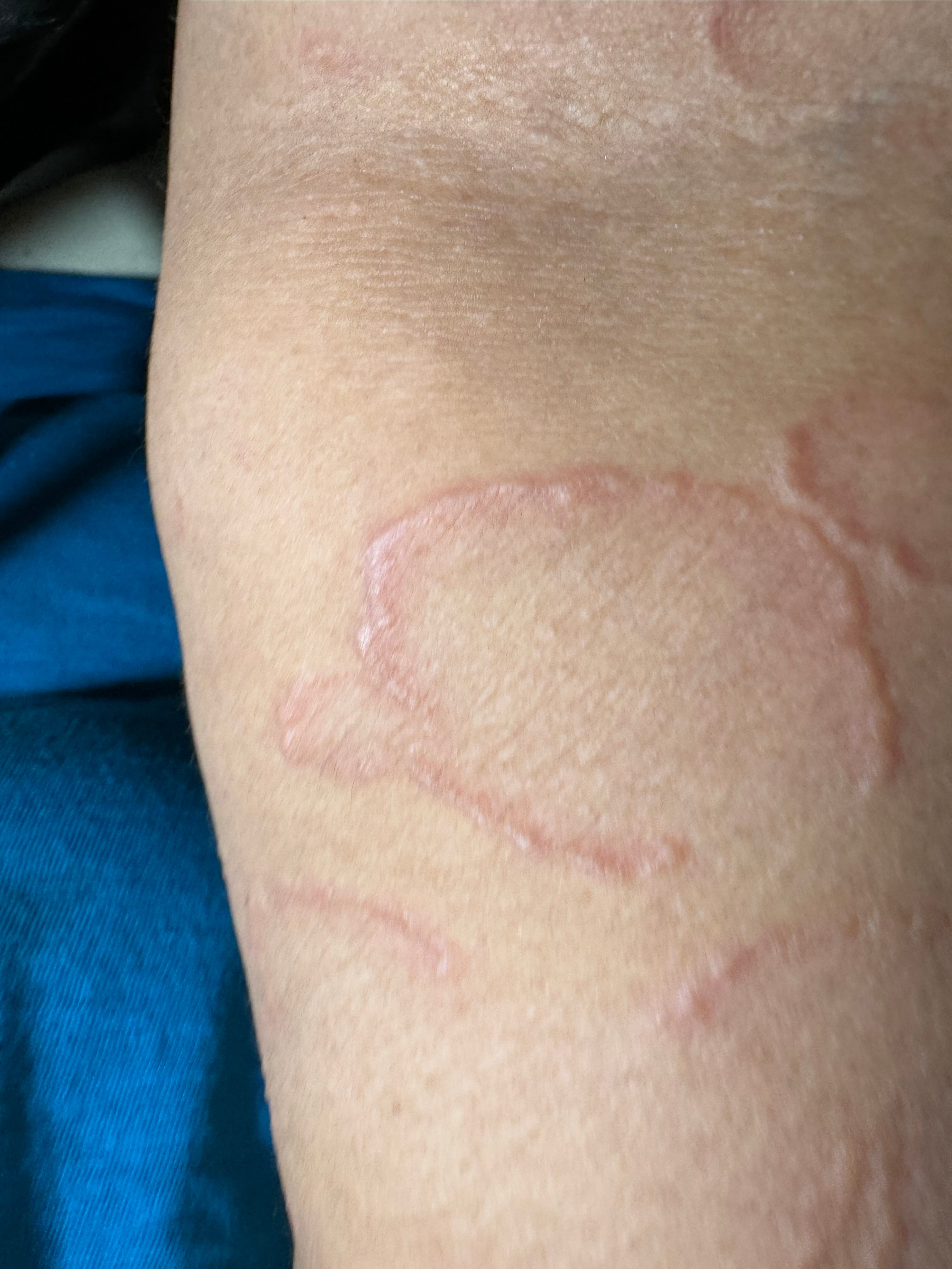 GRANULOMA ANULAR