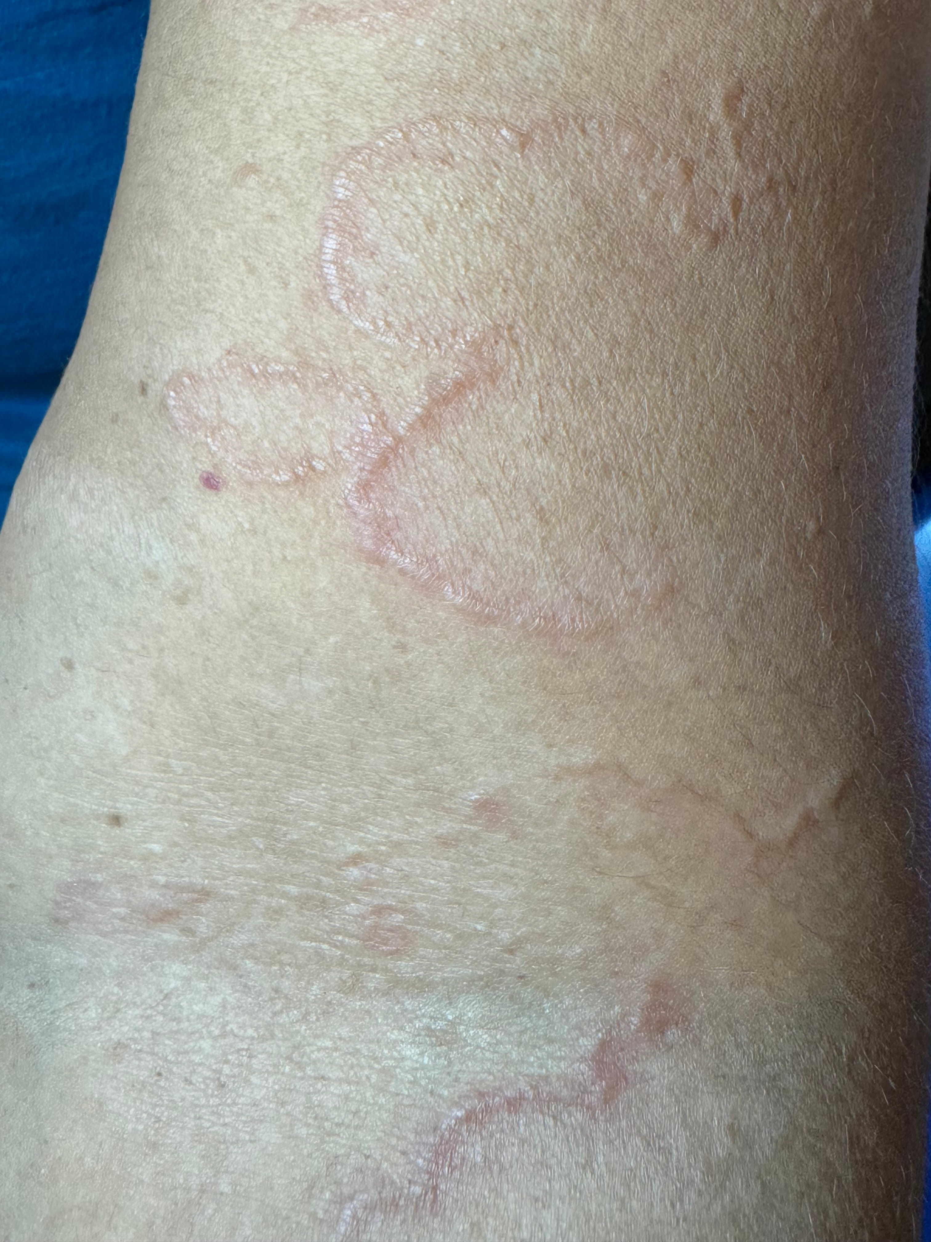GRANULOMA ANULAR