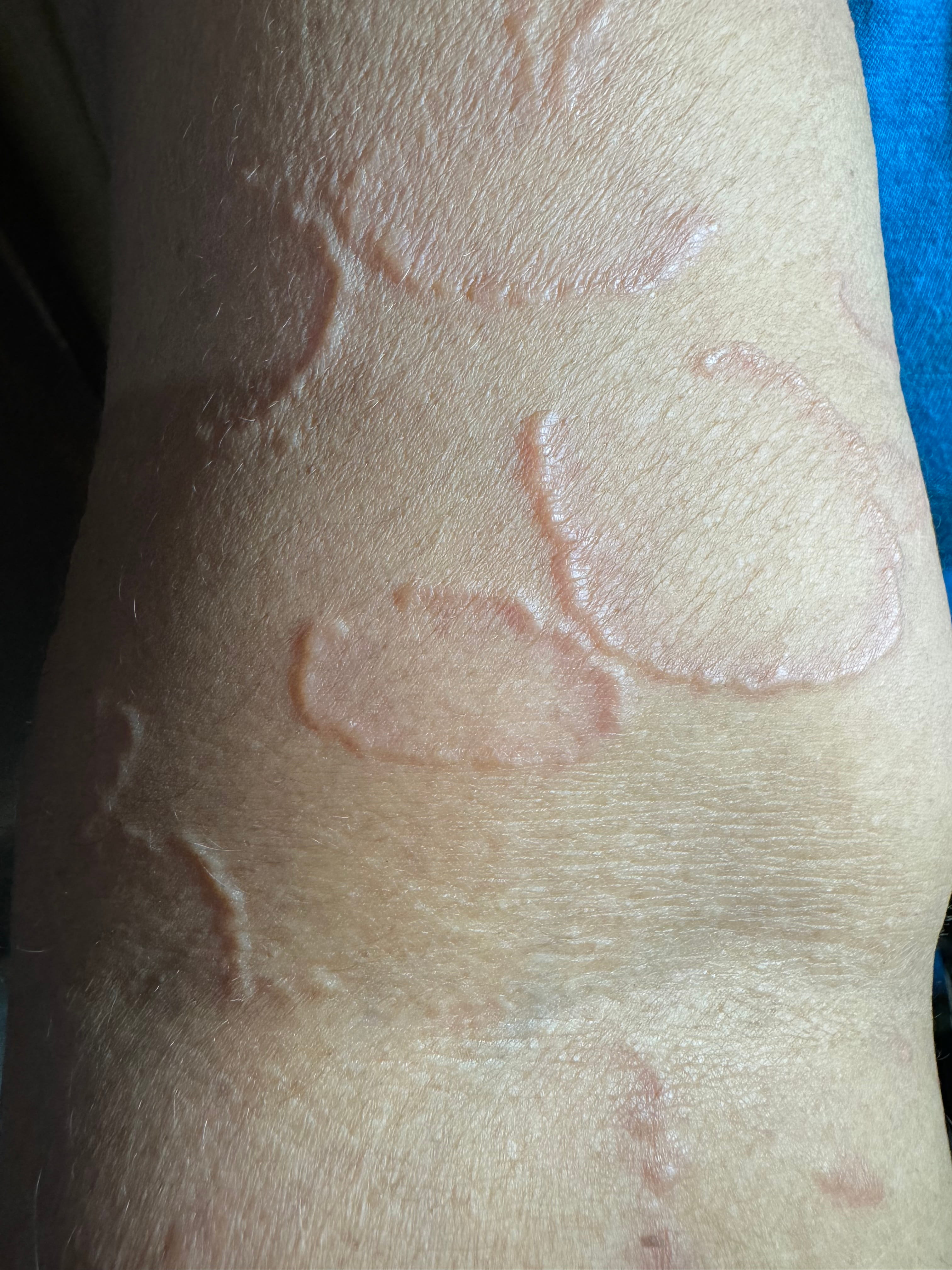 GRANULOMA ANULAR