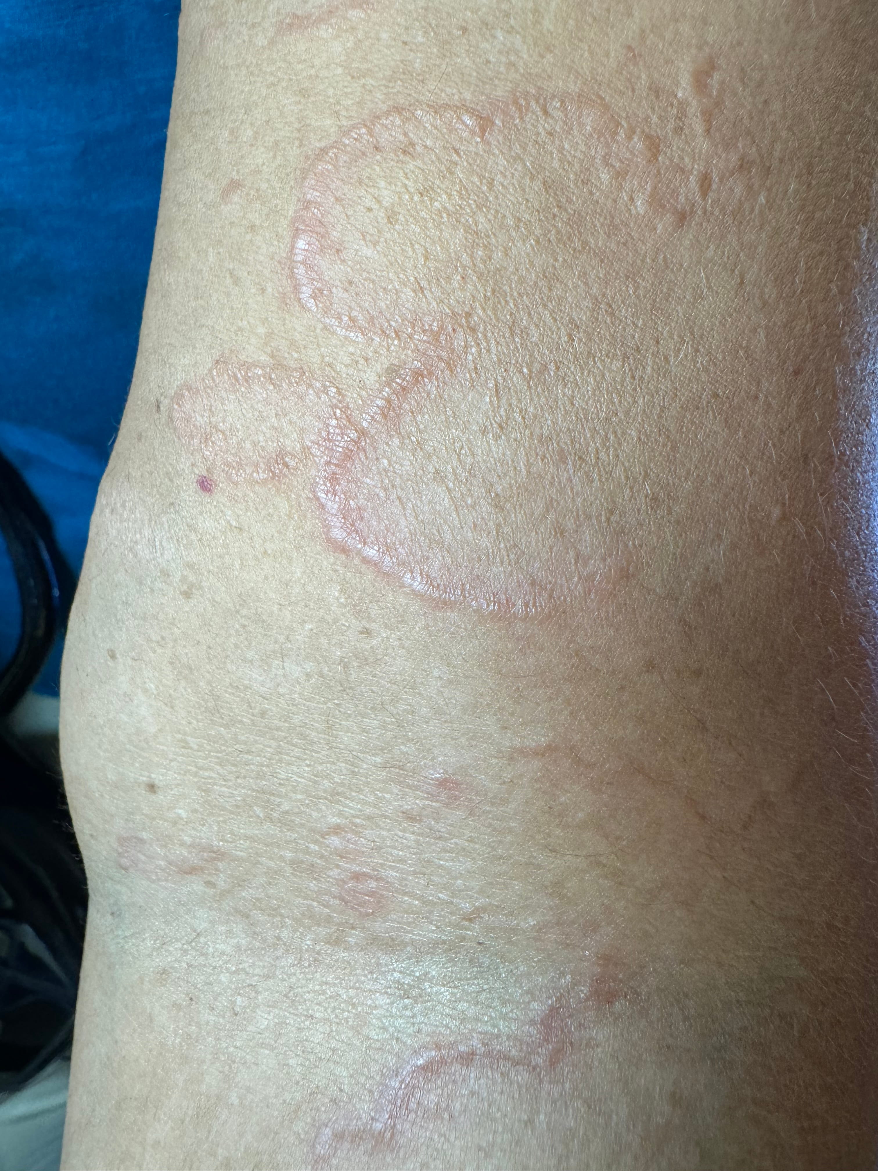 GRANULOMA ANULAR