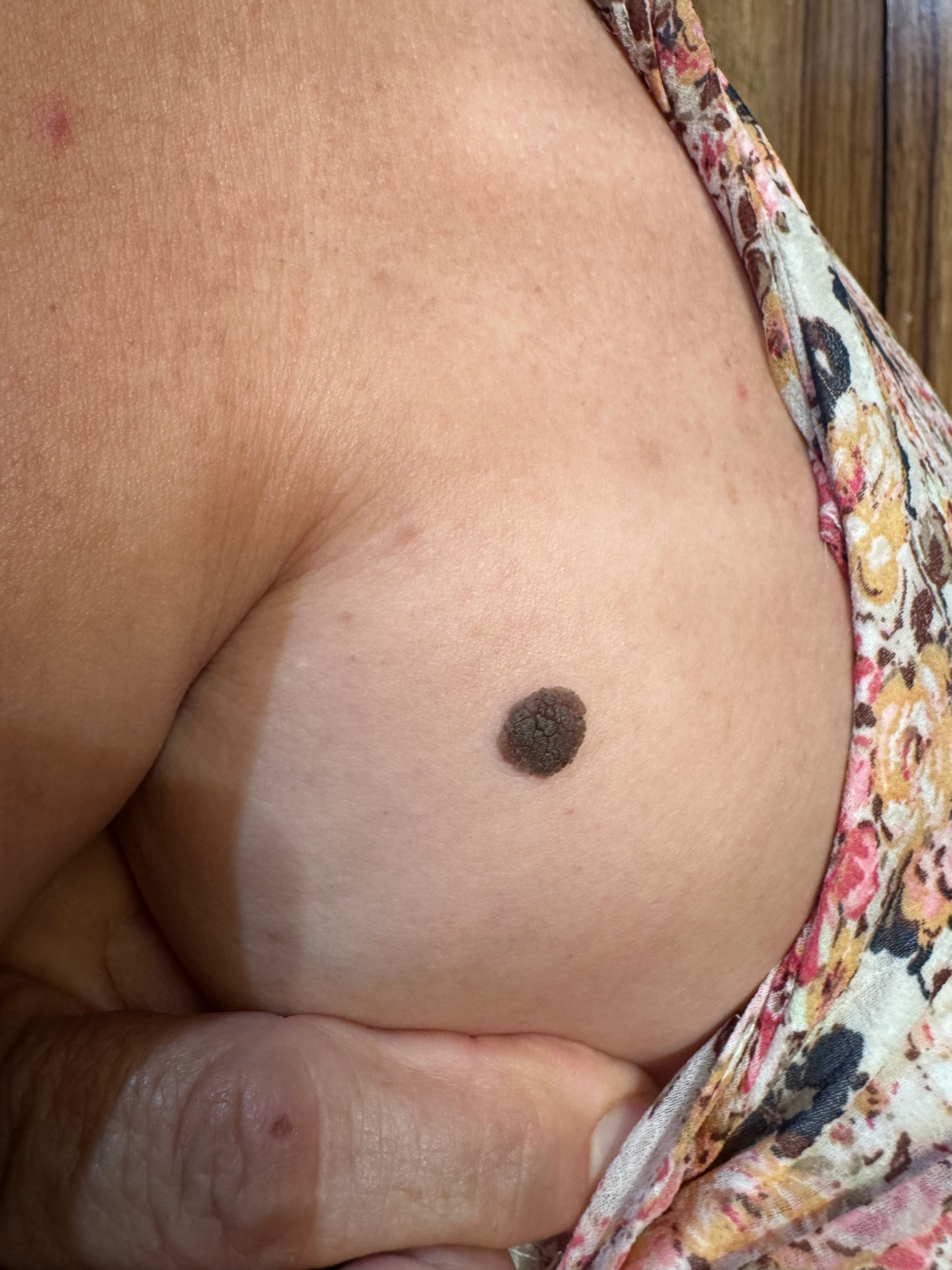 QUERATOSIS SEBORREICA