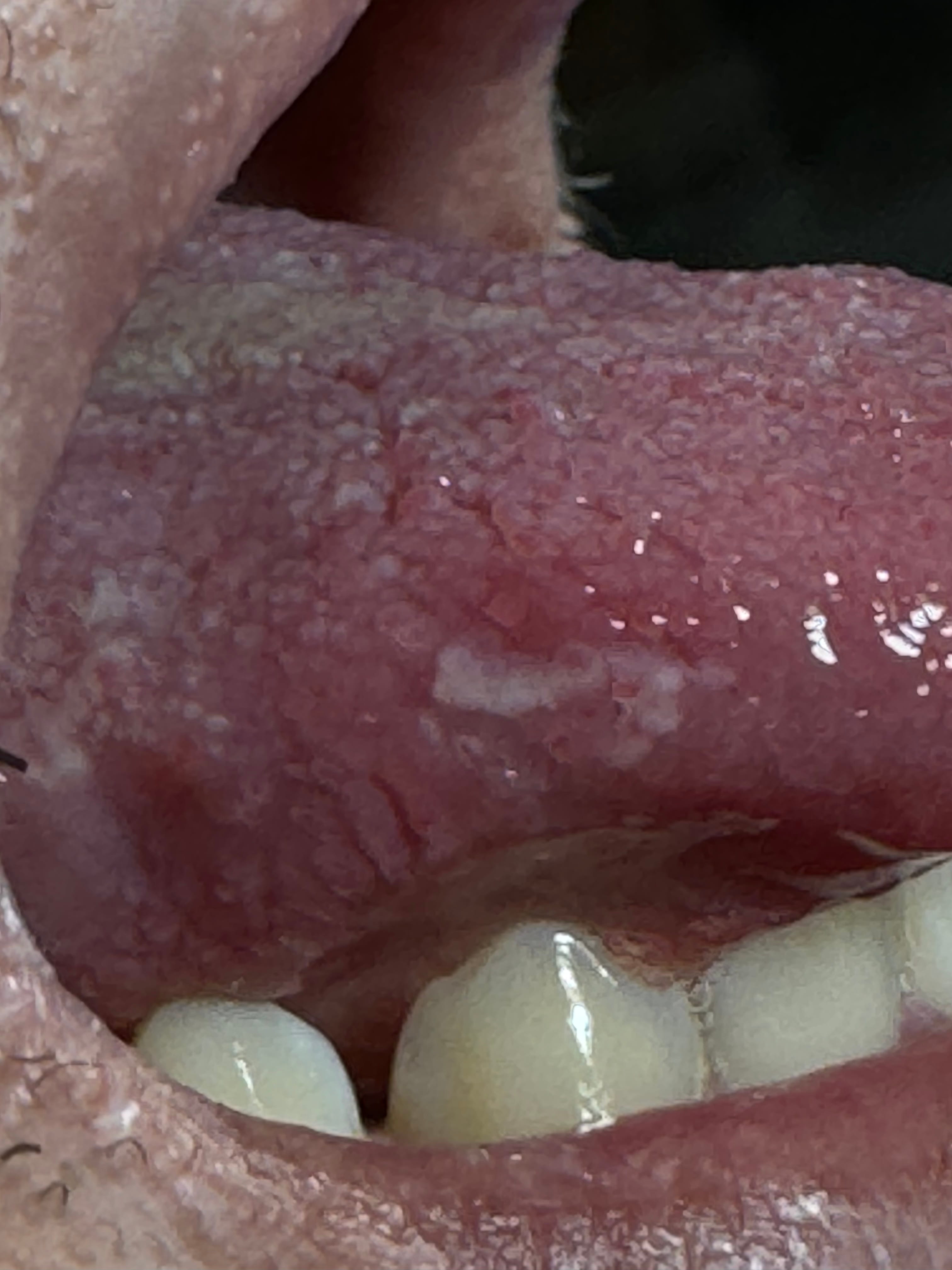 PAPILITIS TRAUMATICA