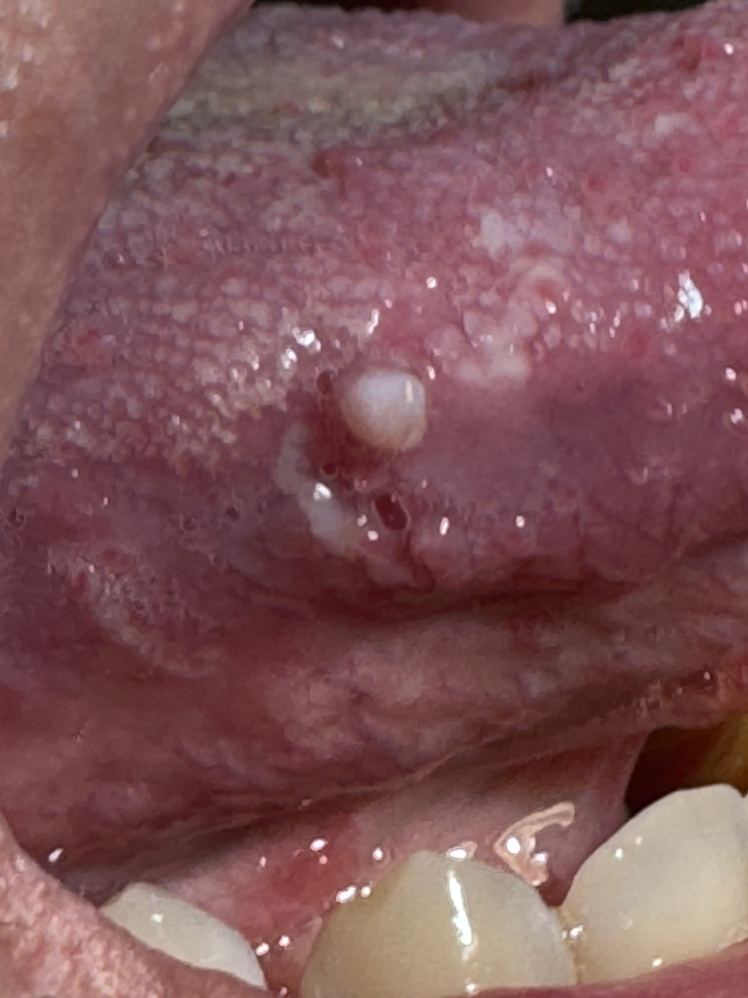 PAPILITIS TRAUMATICA