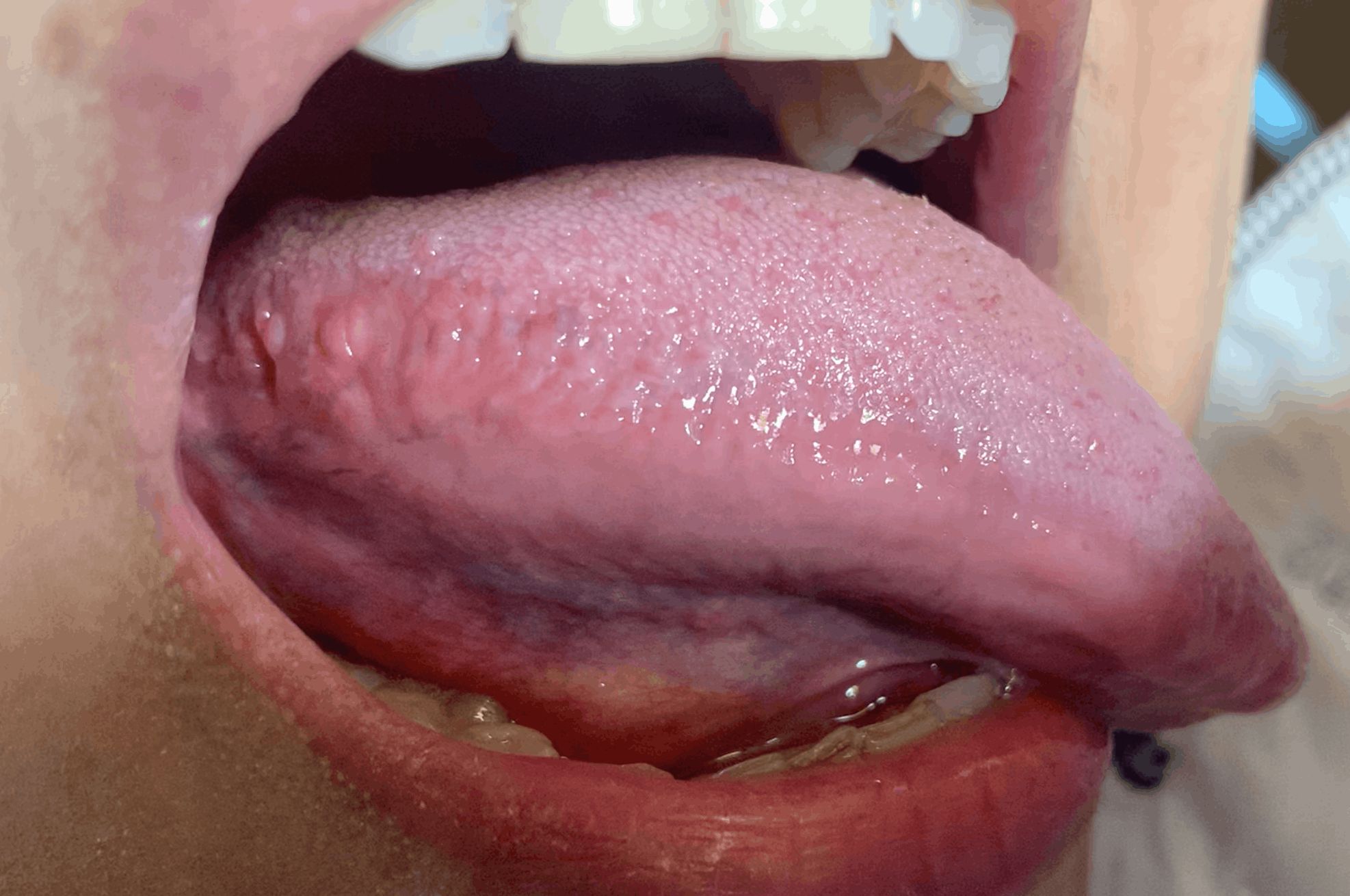 PAPILITIS TRAUMATICA