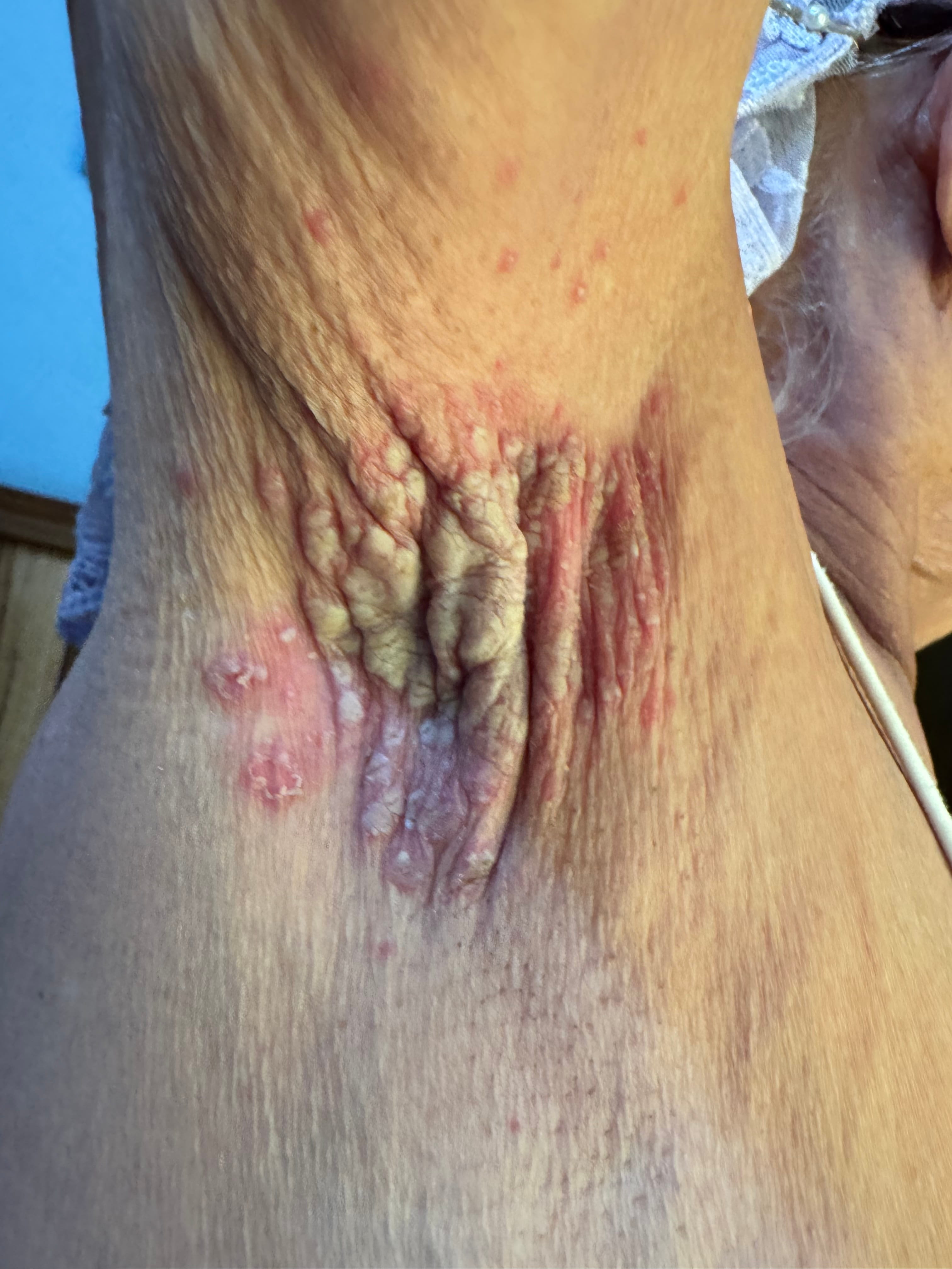 CANDIDOSIS AXILAR y Diabetes