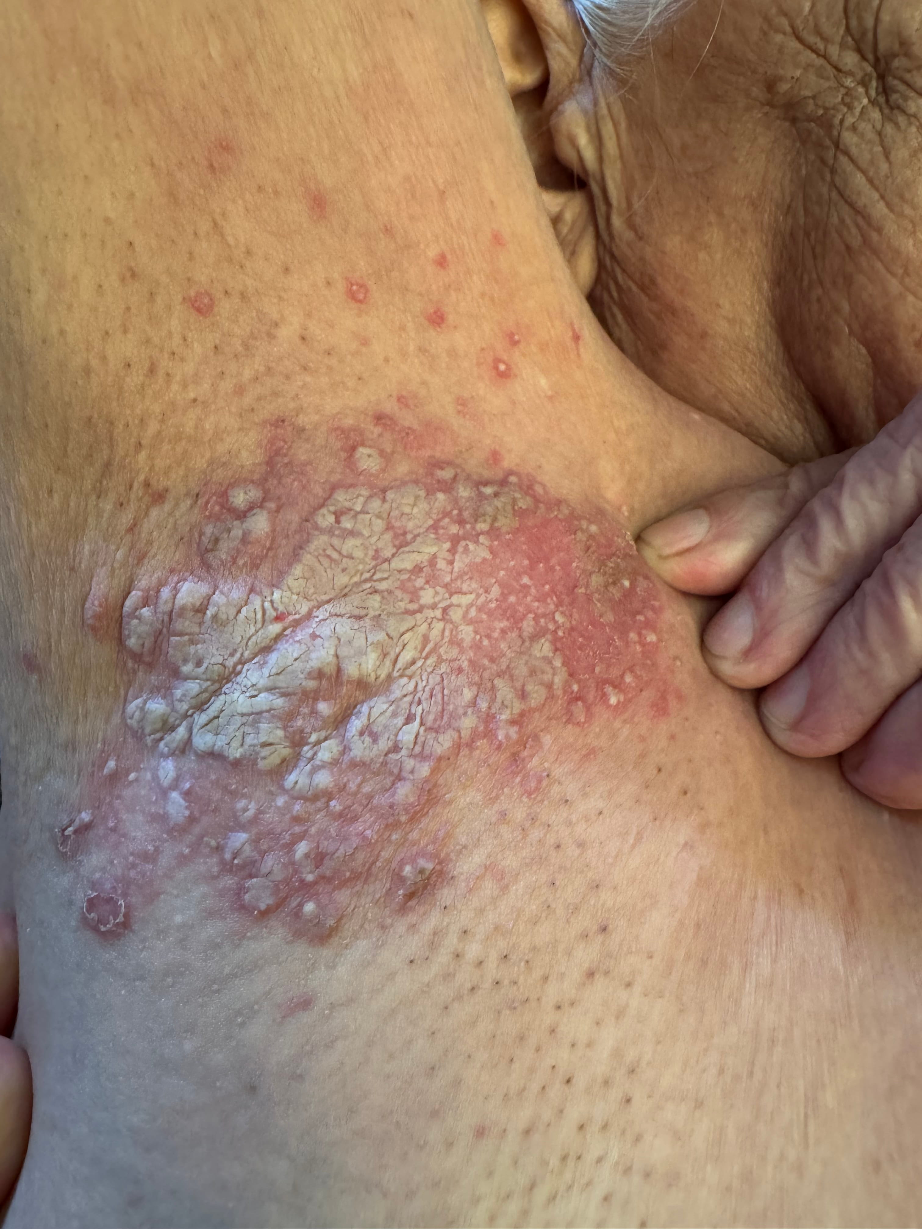 CANDIDOSIS AXILAR y Diabetes