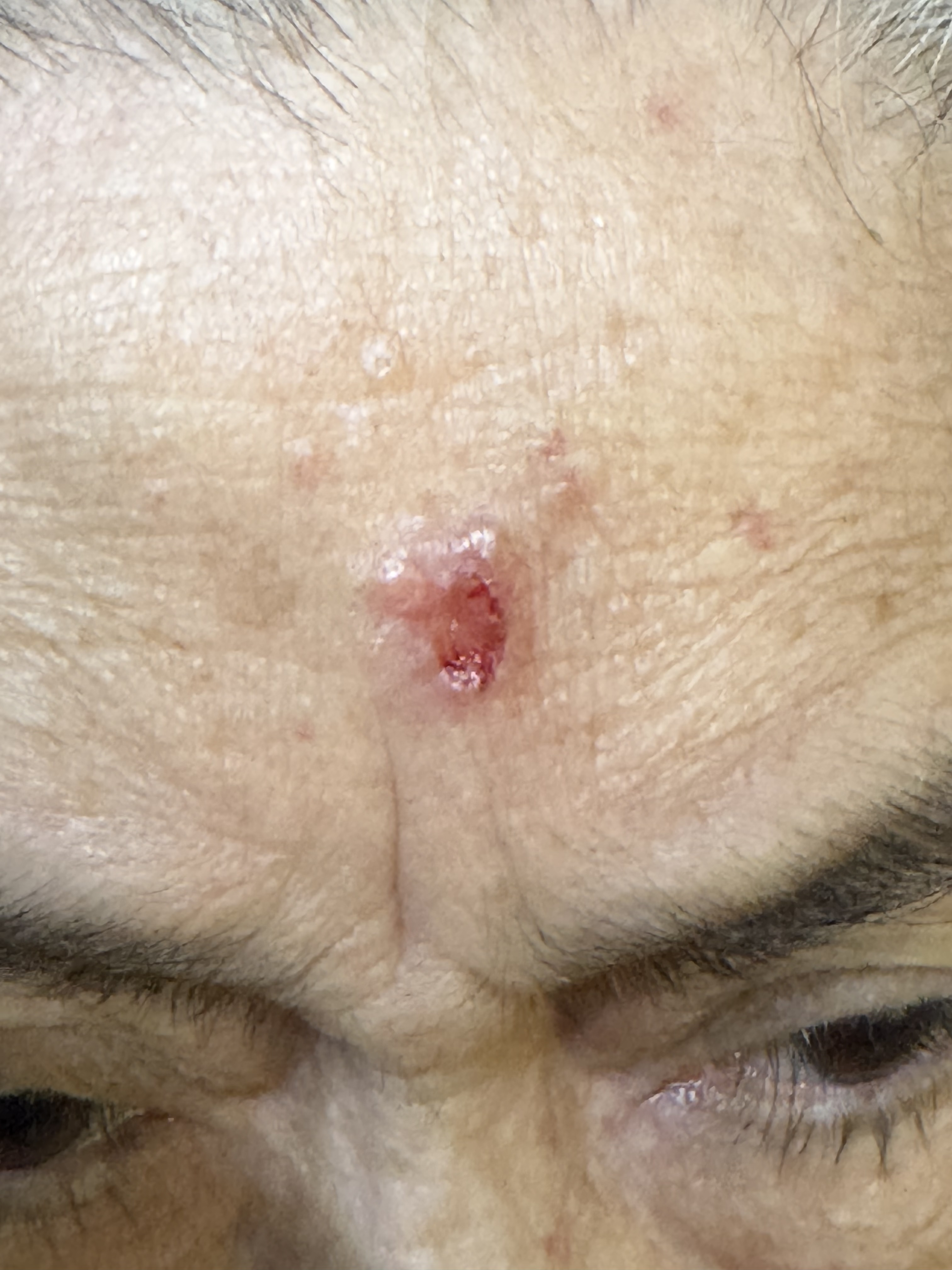 CARCINOMA BASOCELULAR ULCERADO