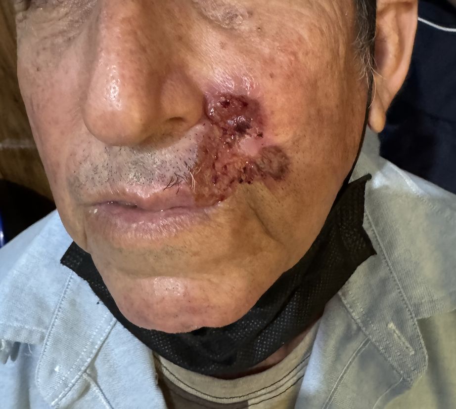 CARCINOMA BASOCELULAR ULCERADO