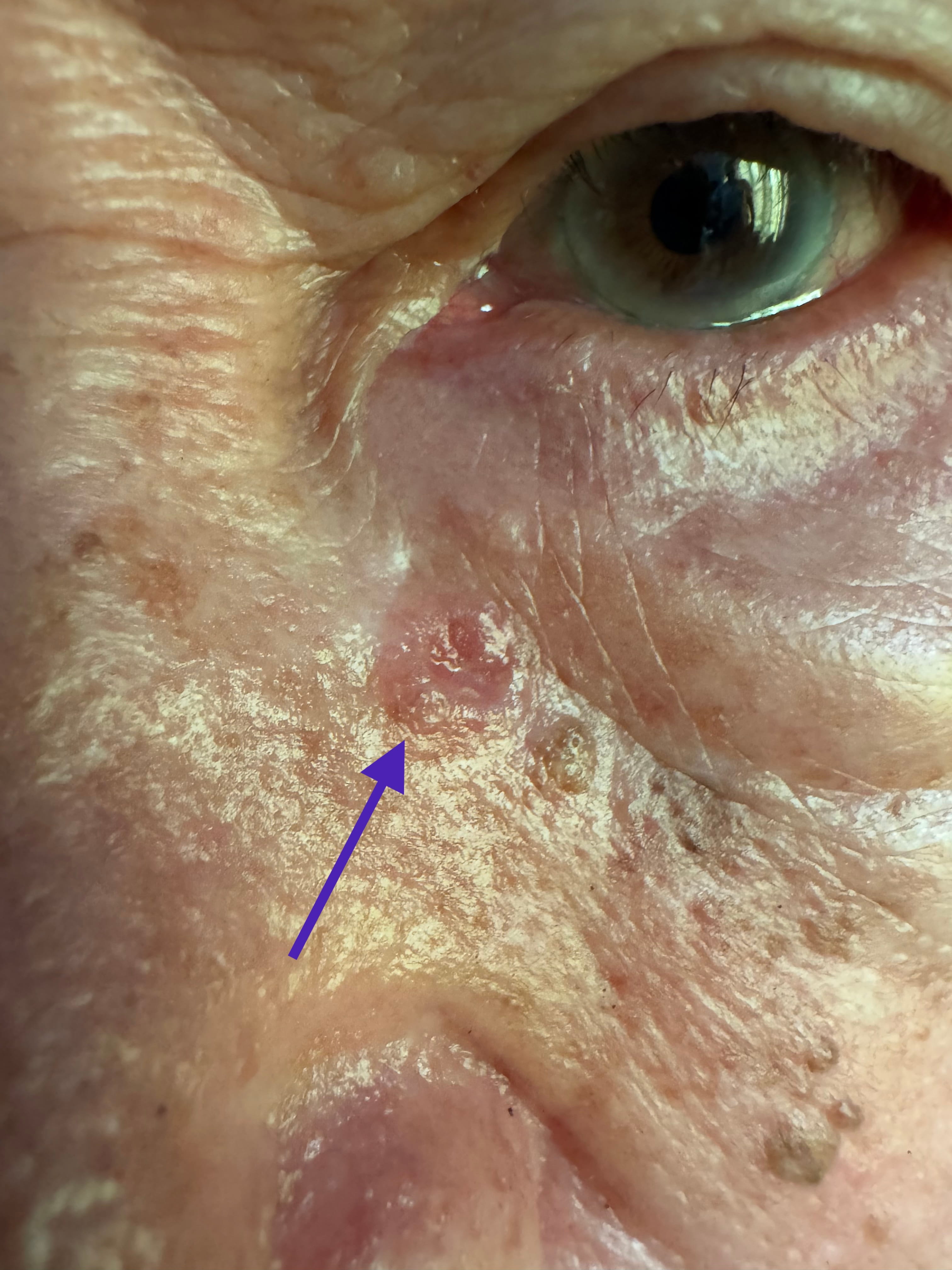 CARCINOMA BASOCELULAR