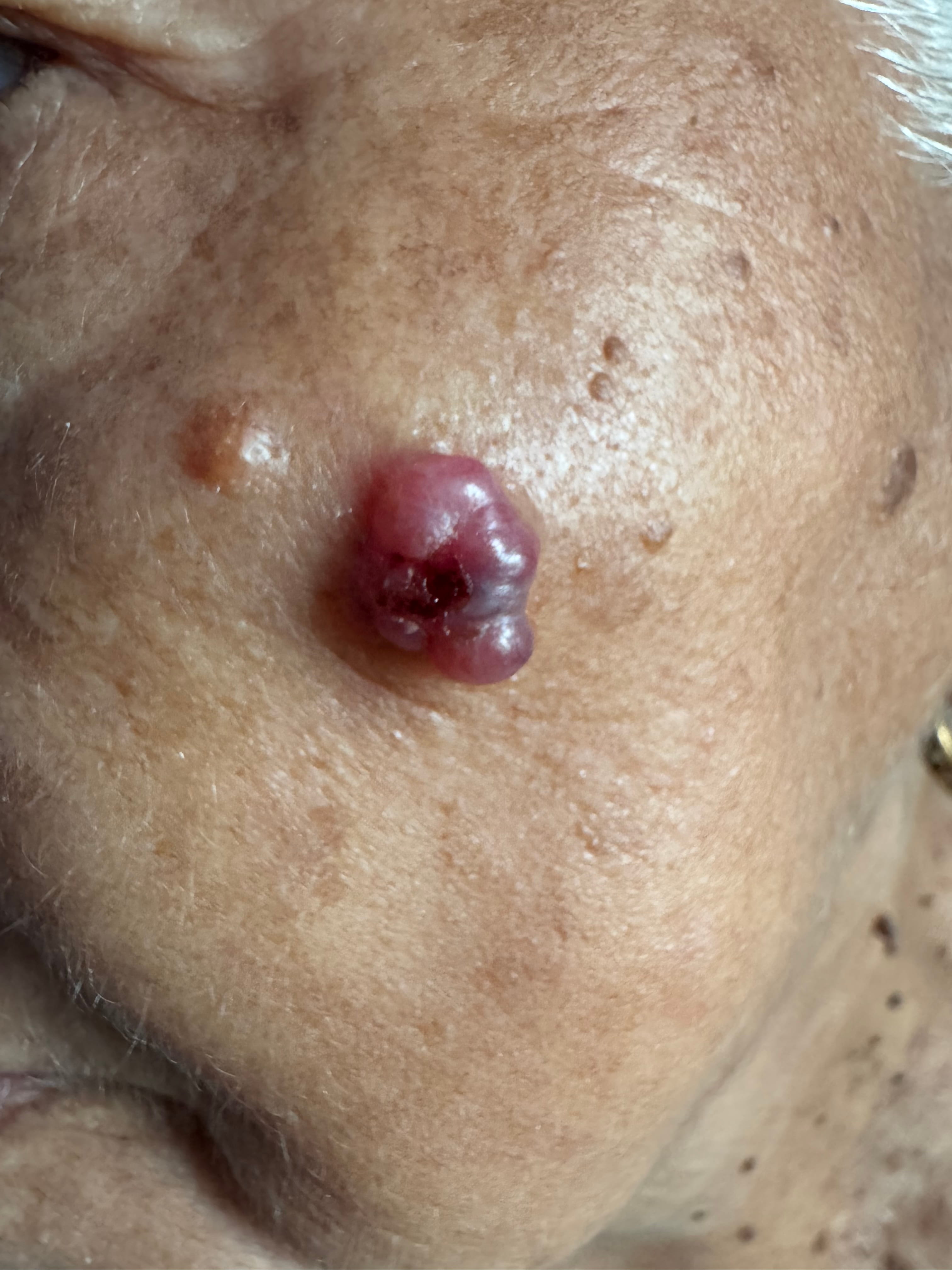 CARCINOMA BASOCELULAR