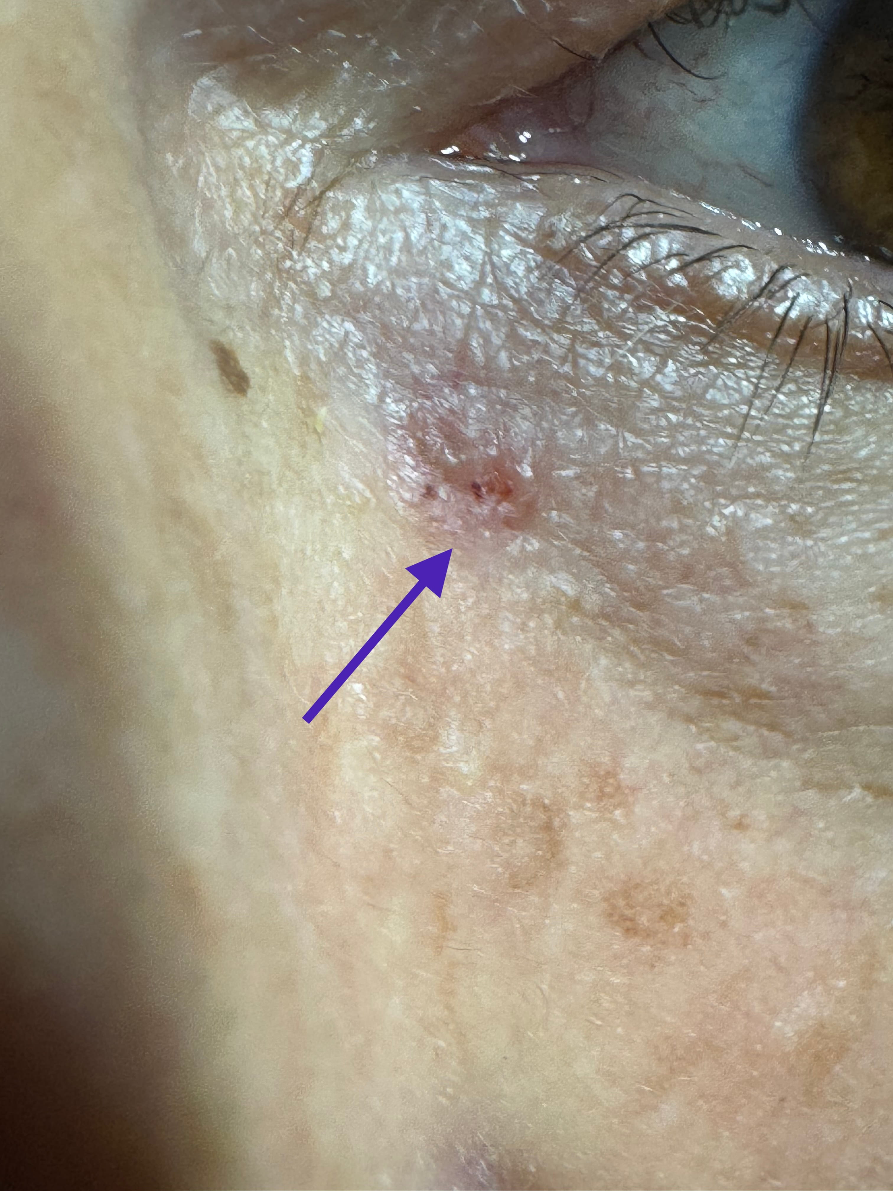 CARCINOMA BASOCELULAR