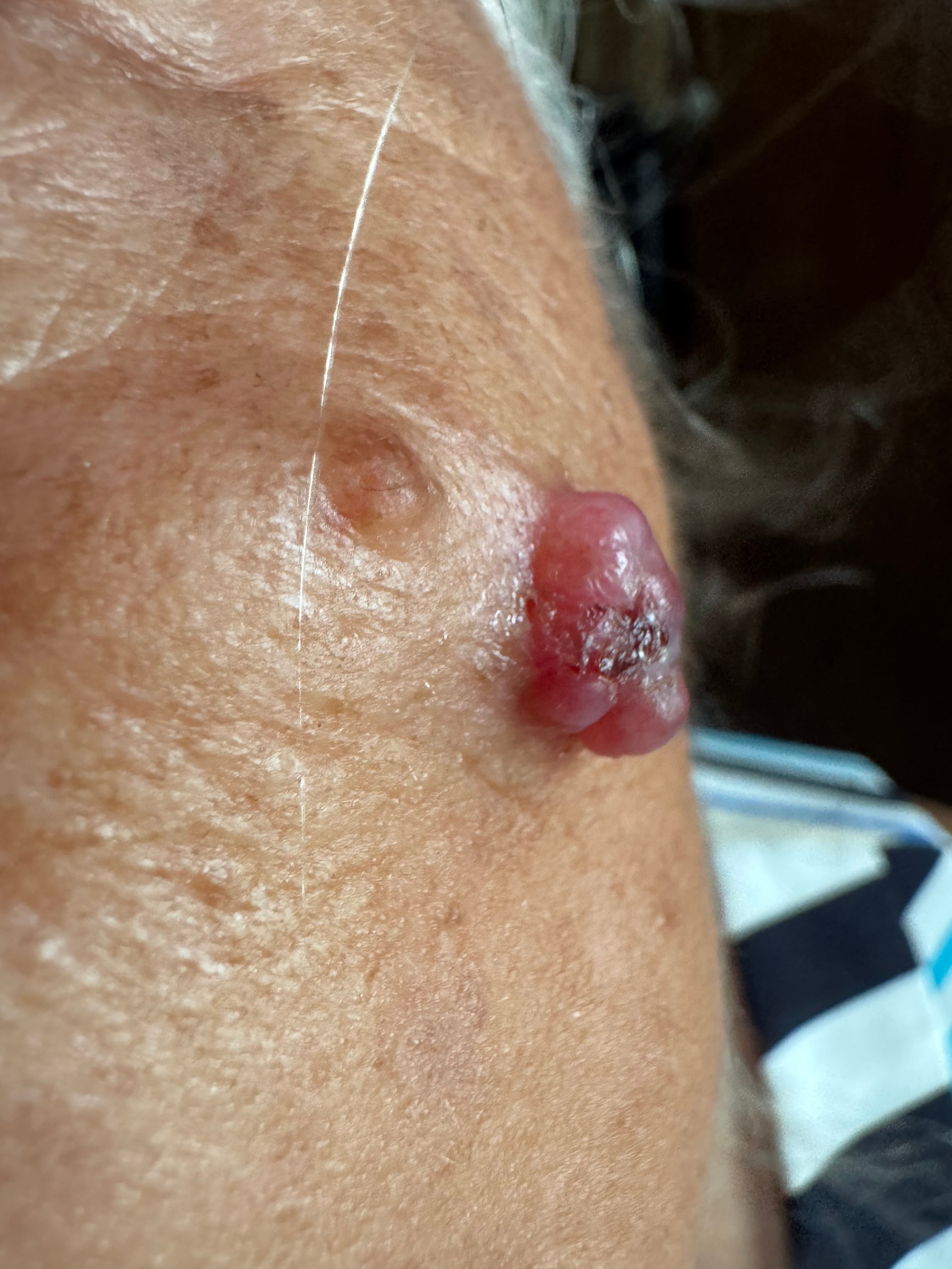 CARCINOMA BASOCELULAR