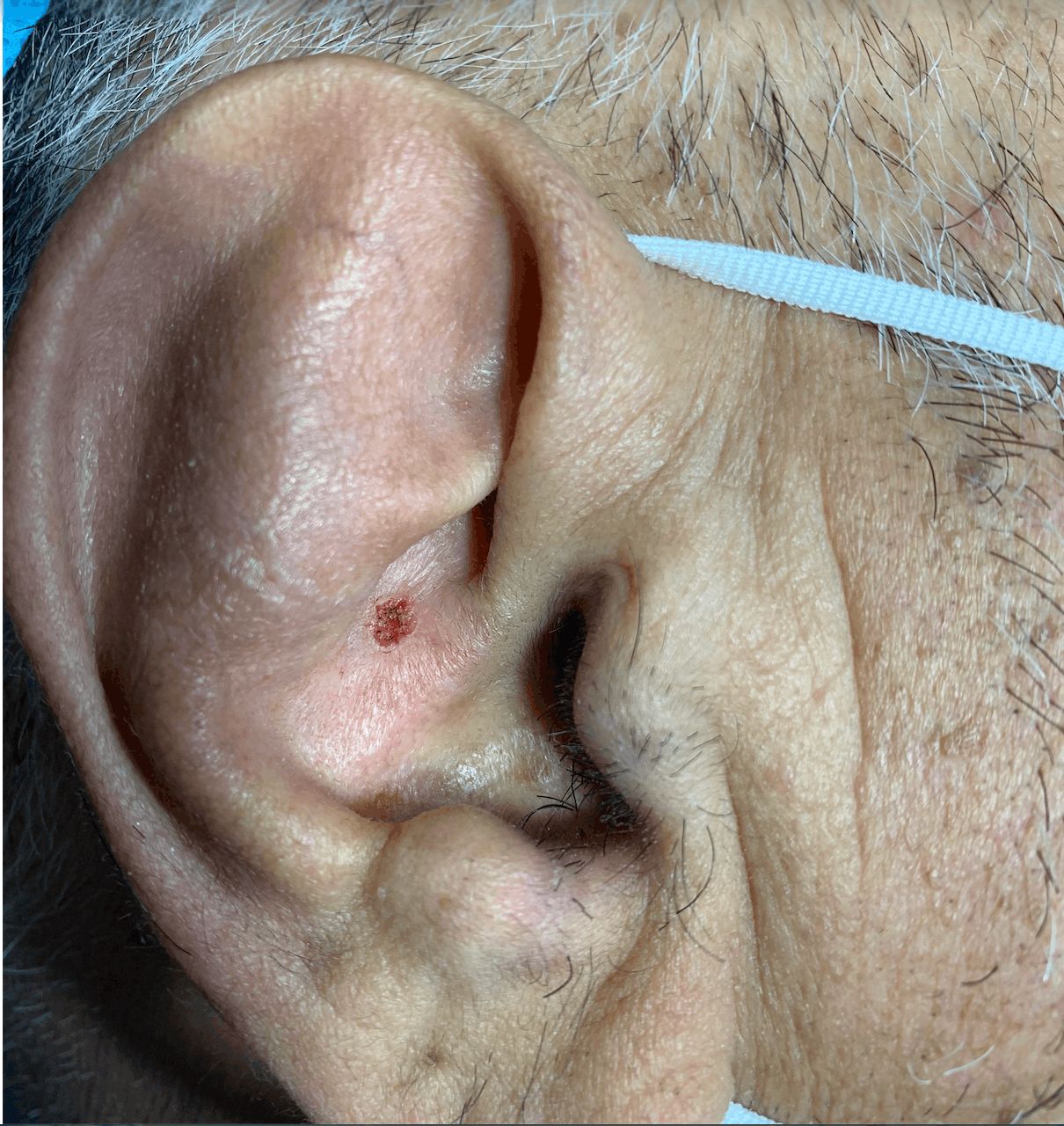 CARCINOMA BASOCELULAR