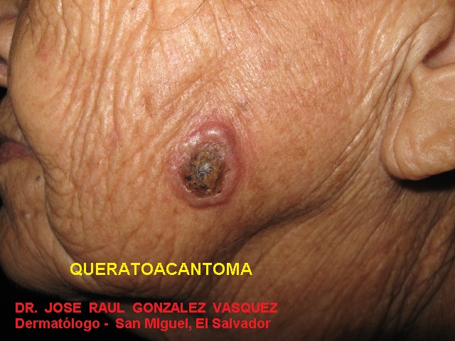 QUERATOACANTOMA