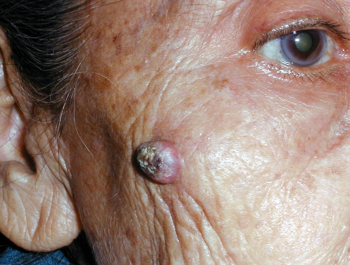 QUERATOACANTOMA