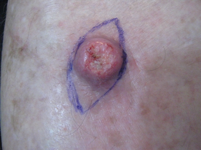 QUERATOACANTOMA