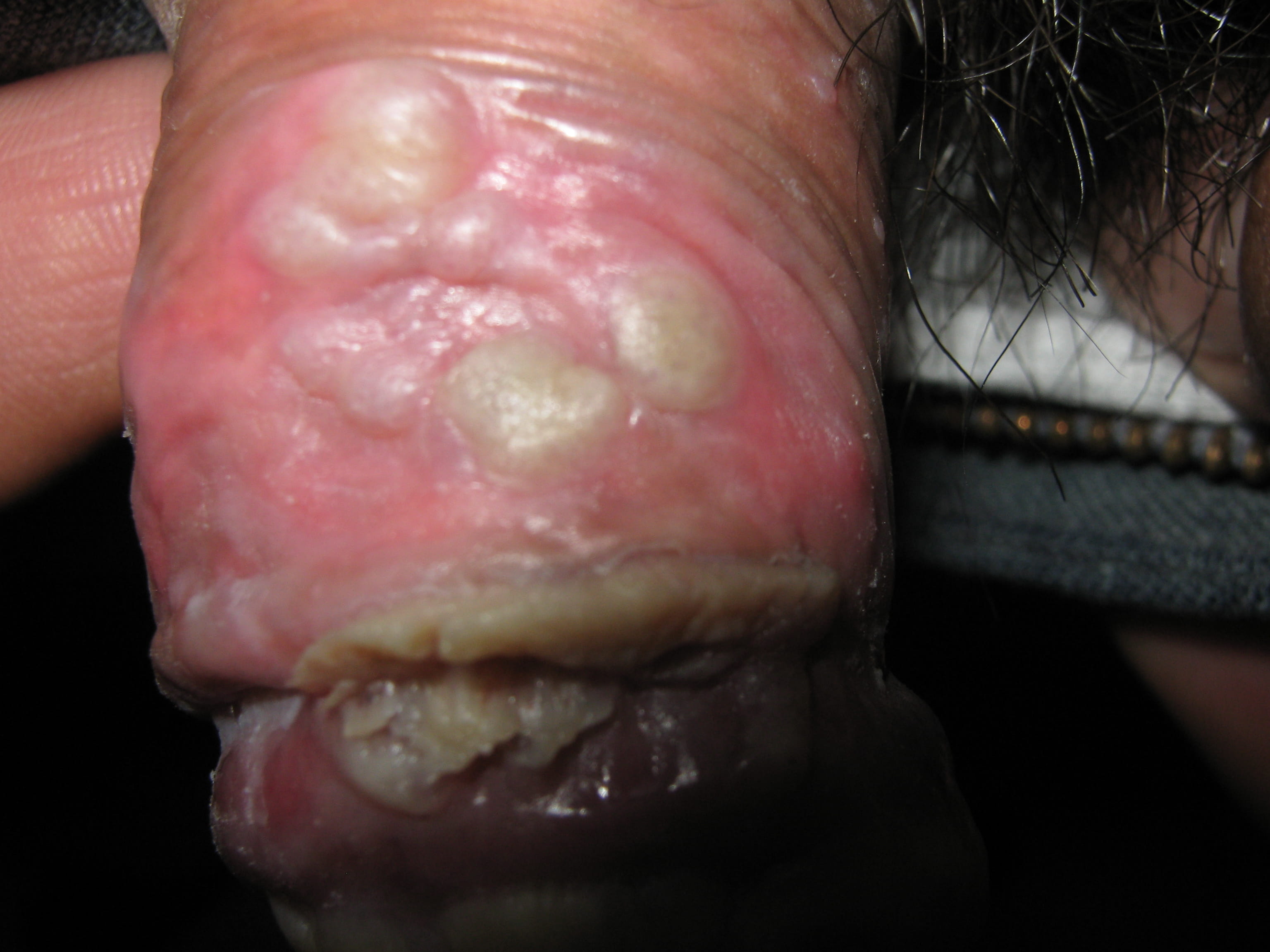 CONDILOMAS ACUMINADOS