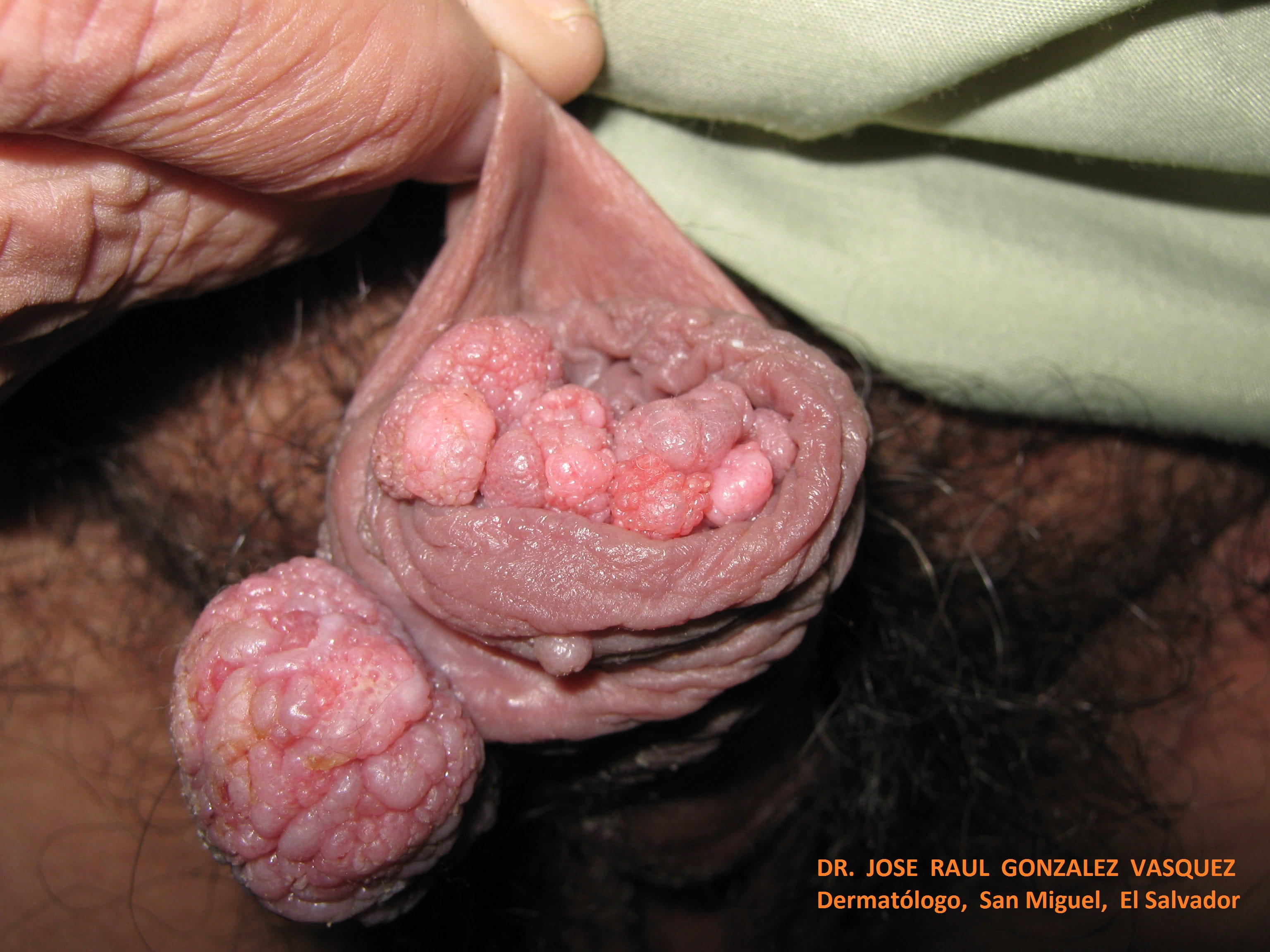 CONDILOMAS ACUMINADOS y transplante renal