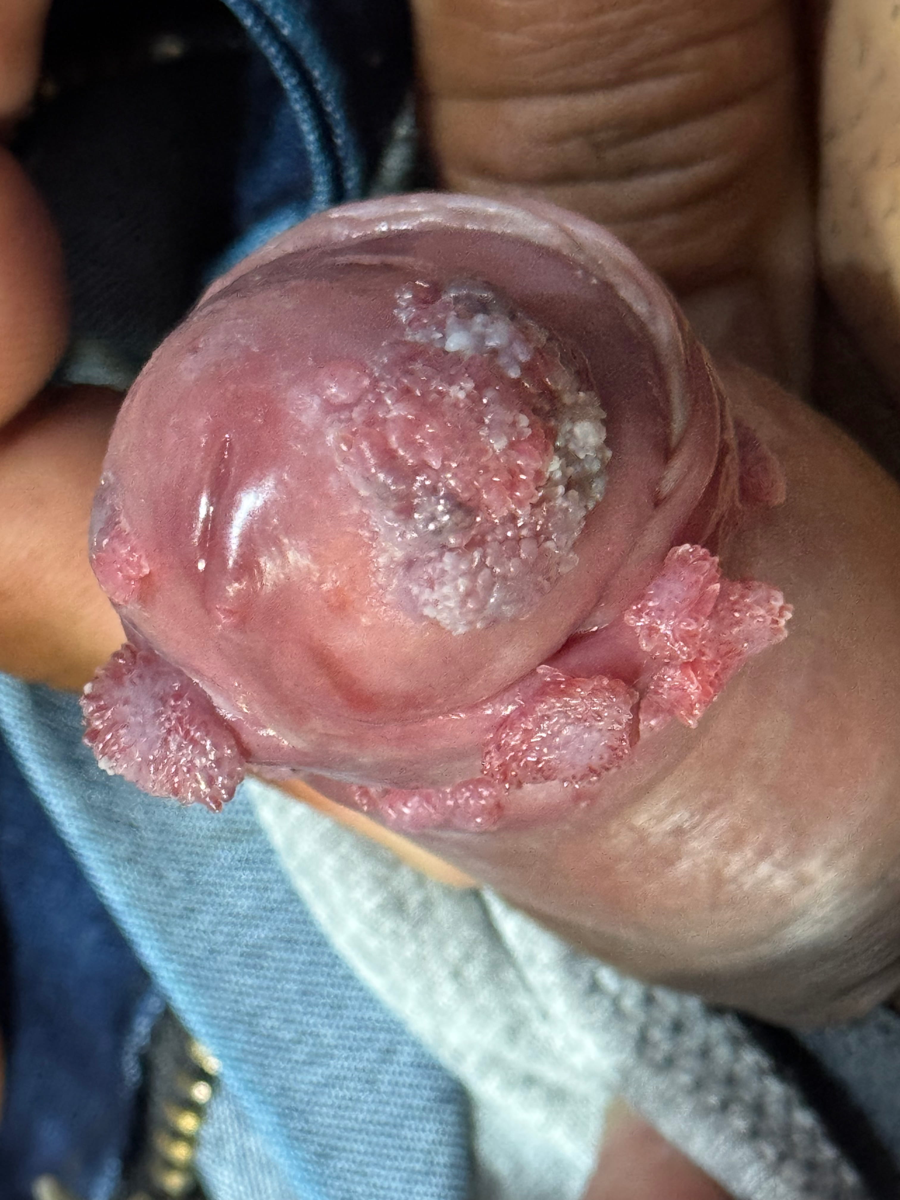 CONDILOMAS ACUMINADOS