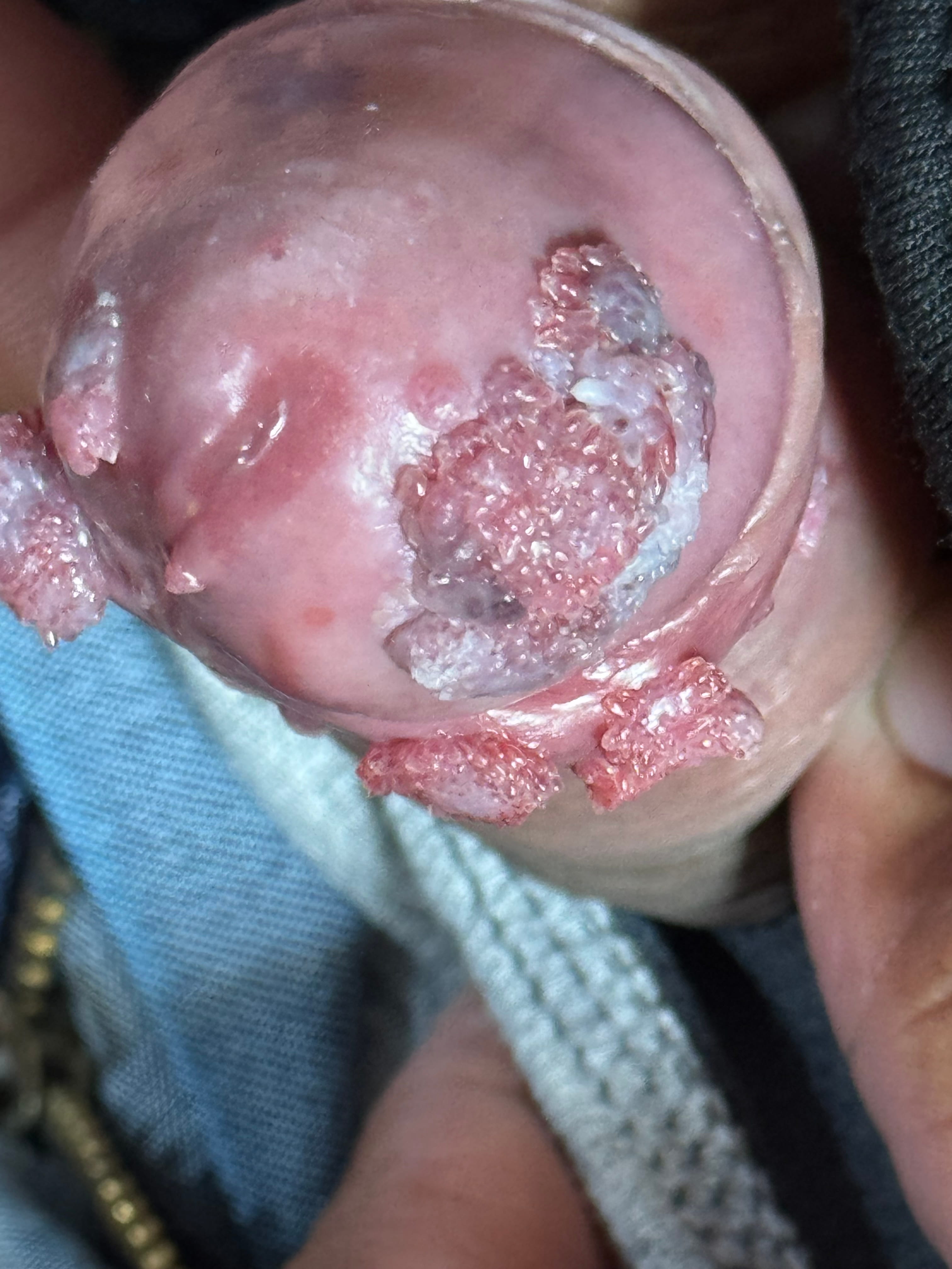 CONDILOMAS ACUMINADOS