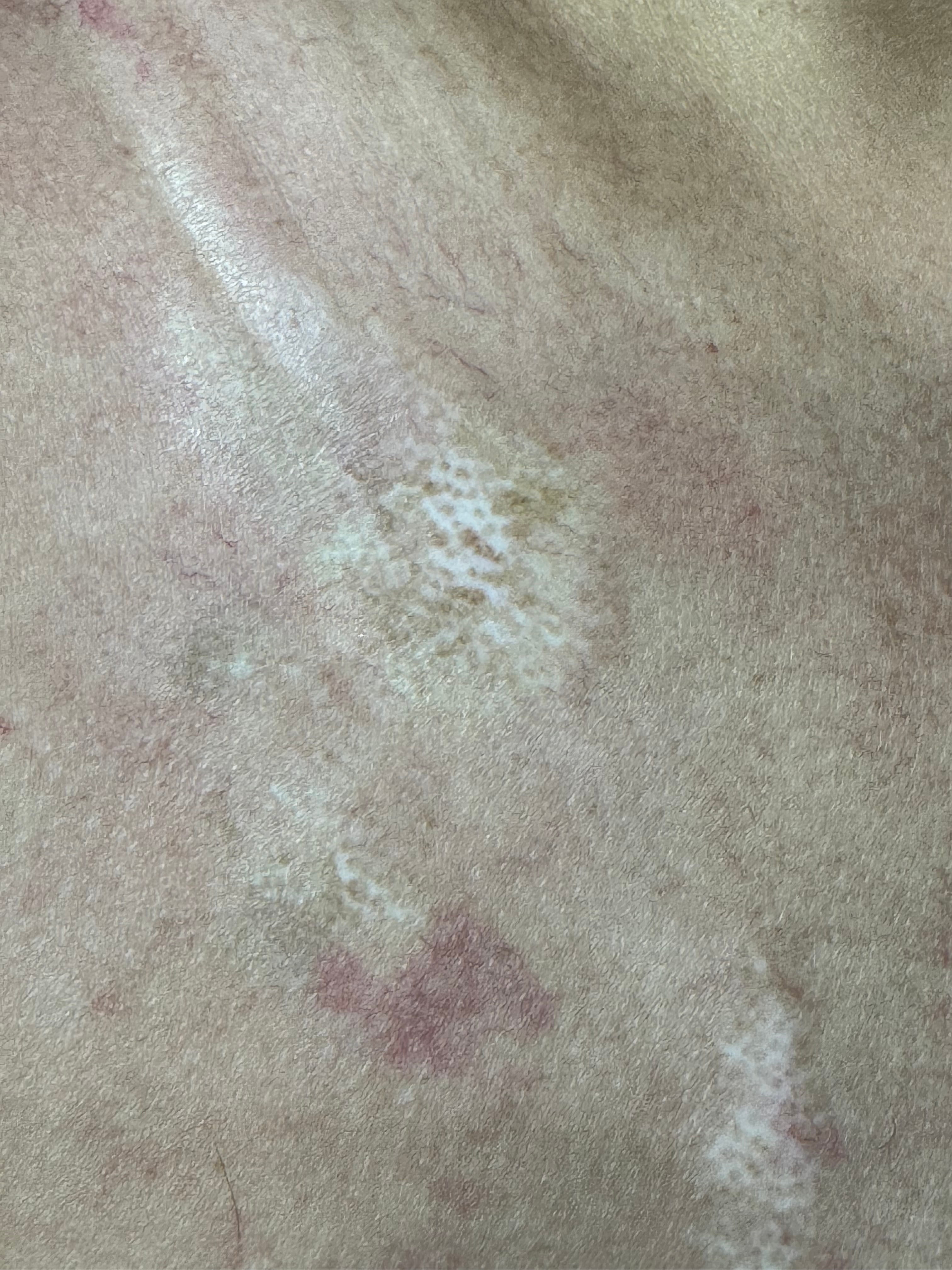 ESCLERODERMIA CUTANEA GENERALIZADA