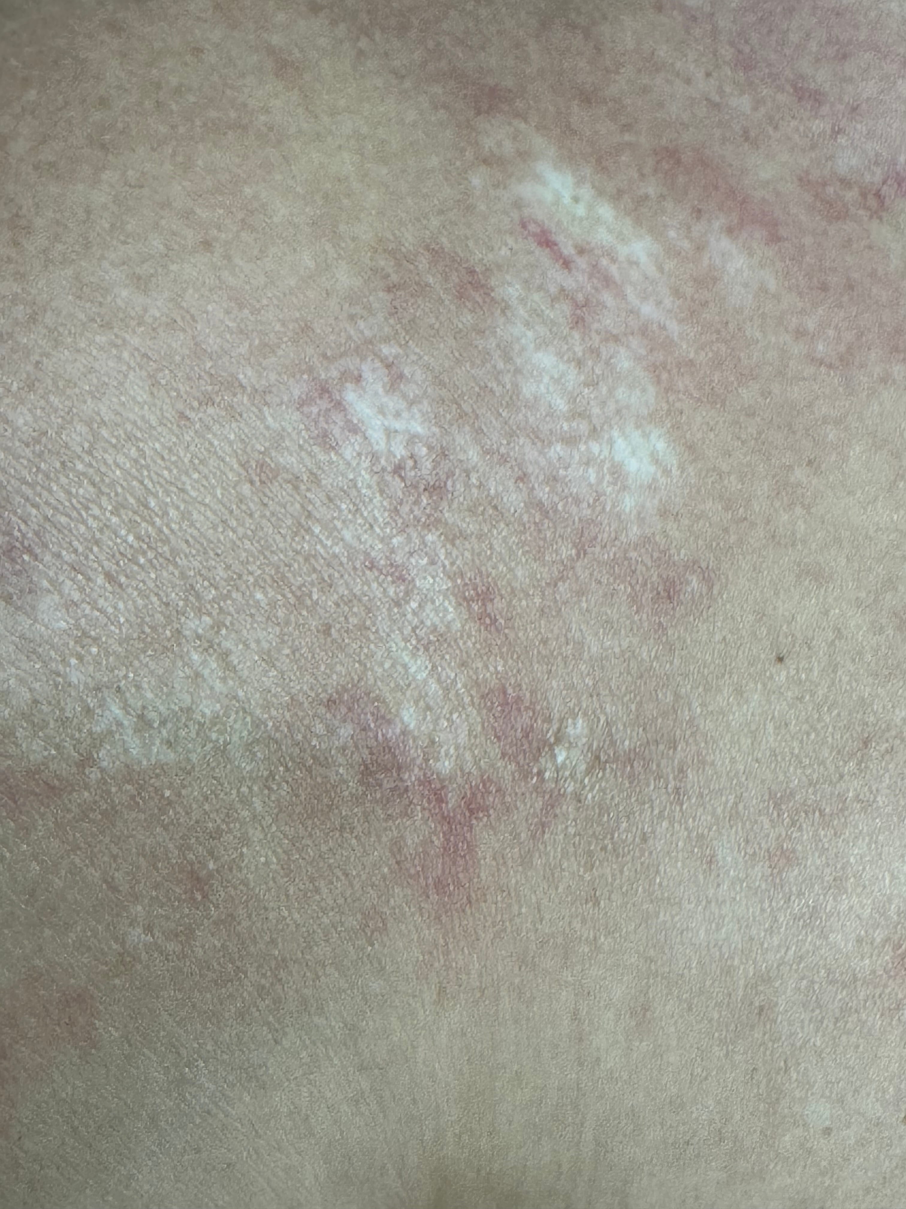 ESCLERODERMIA CUTANEA GENERALIZADA