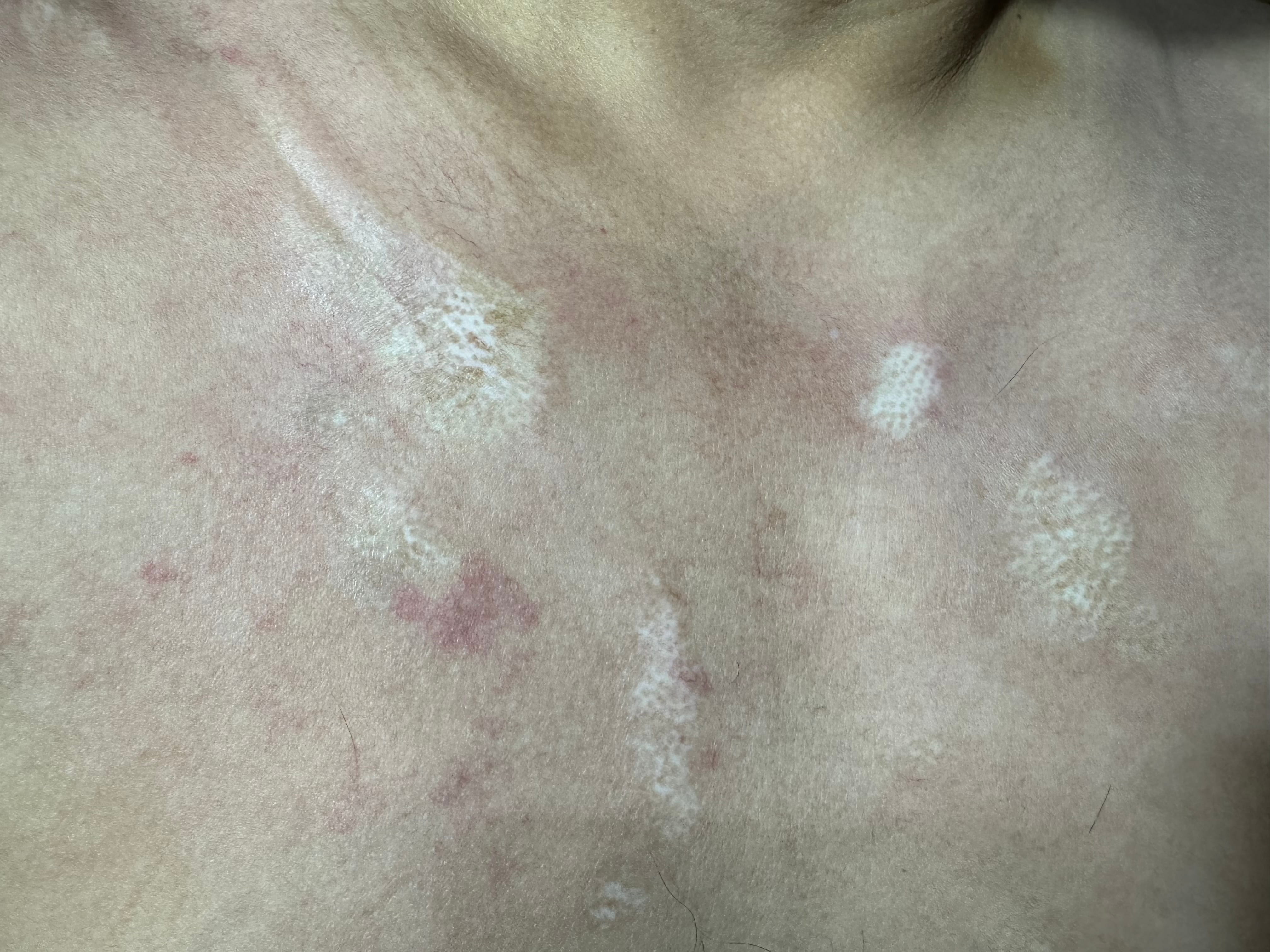 ESCLERODERMIA CUTANEA GENERALIZADA