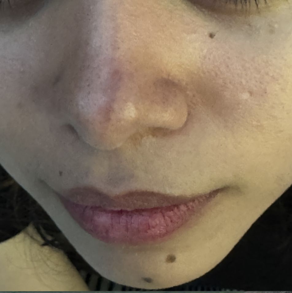 ESCLERODERMIA CUTANEA LINEAL