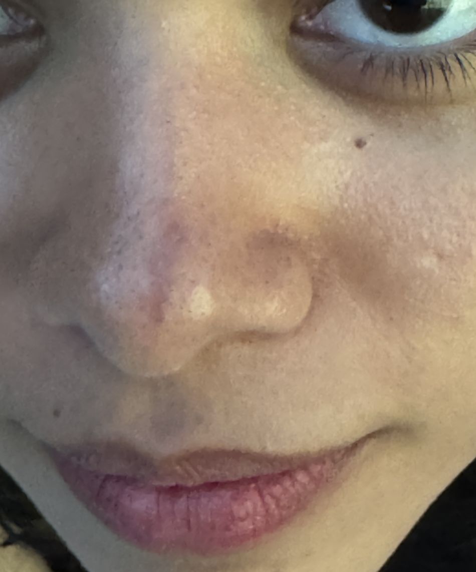 ESCLERODERMIA CUTANEA LINEAL