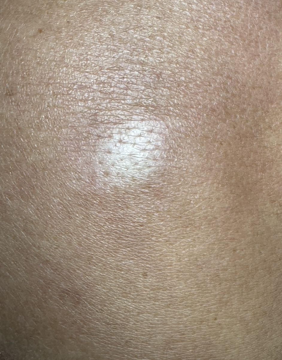 ESCLERODERMIA CUTANEA GENERALIZADA - Mancha acrómica