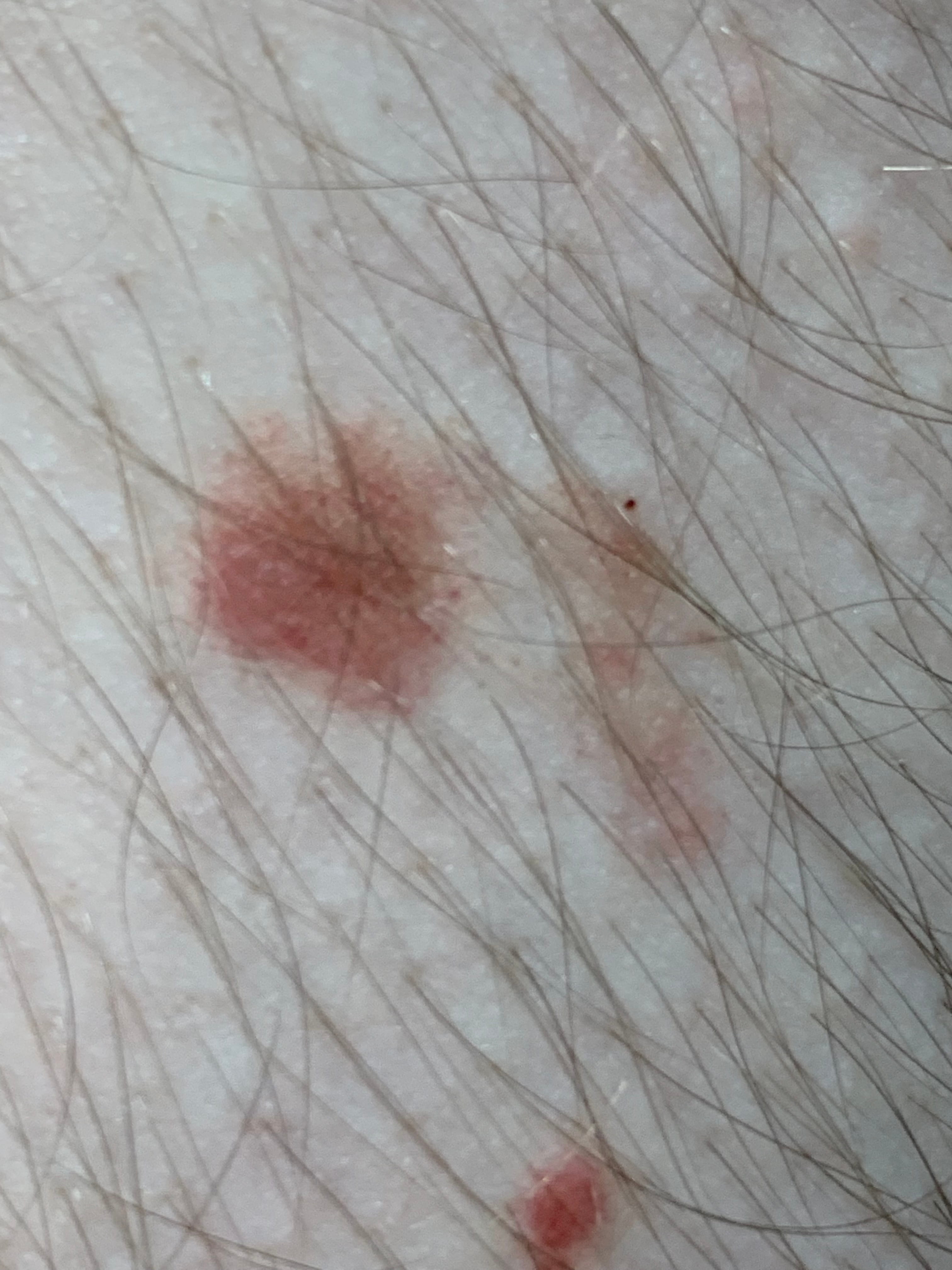 LIQUEN AUREUS