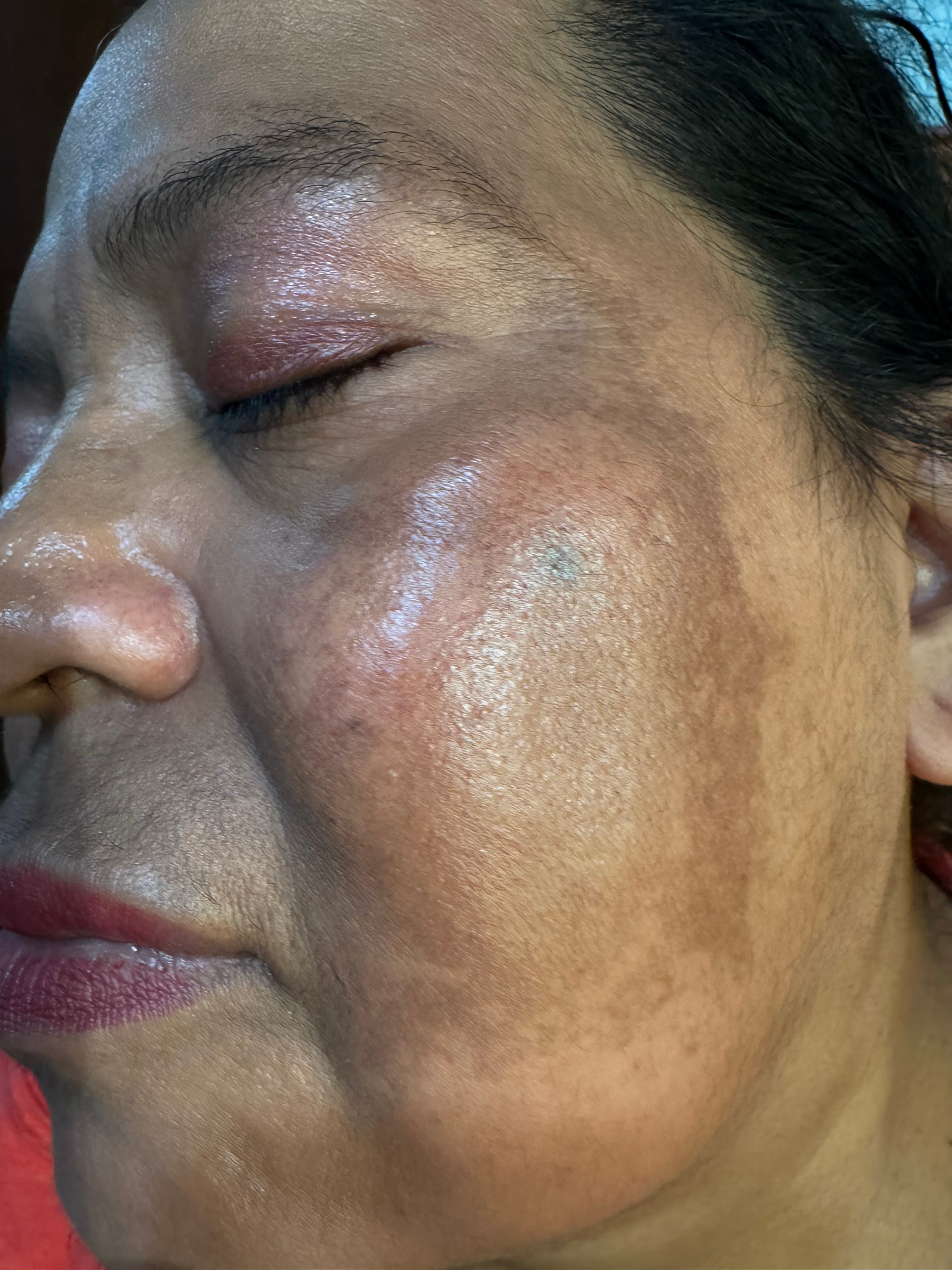 MELASMA