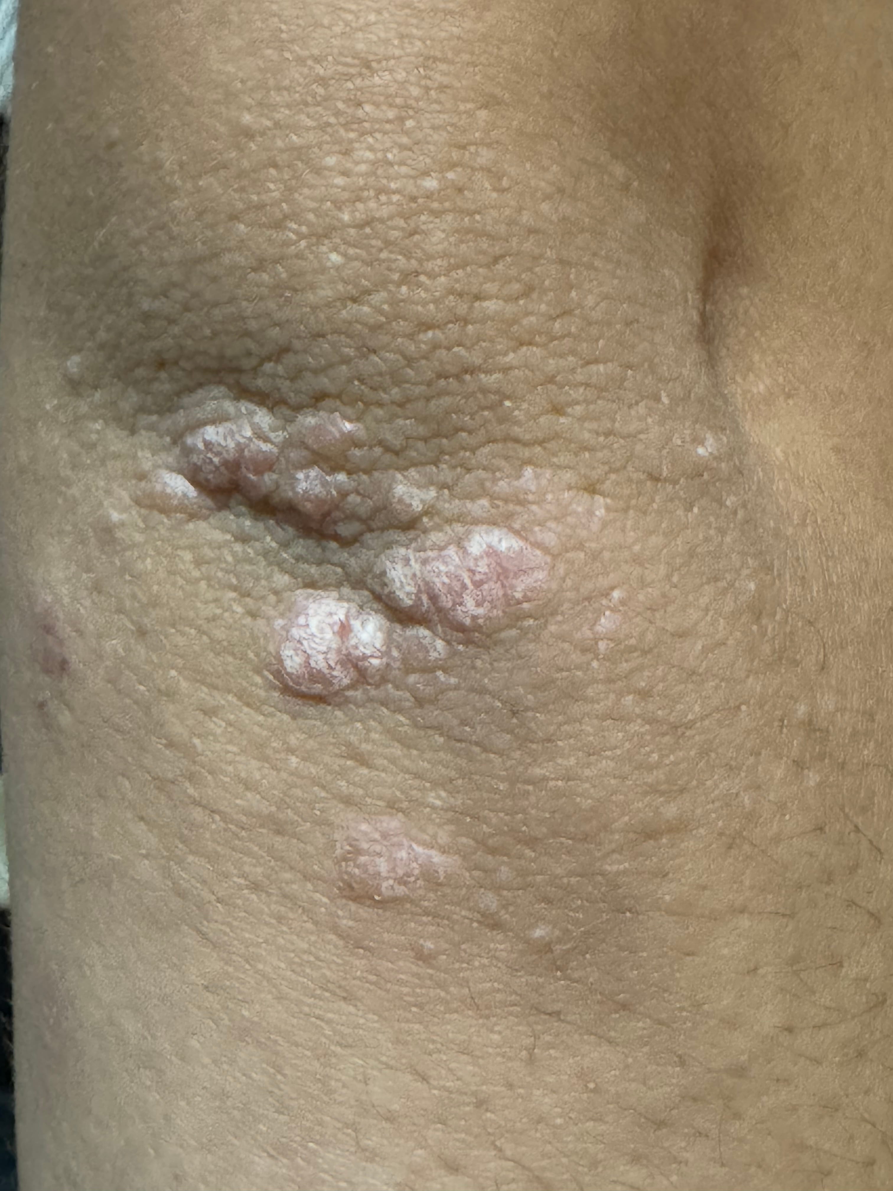 PSORIASIS en adolescente