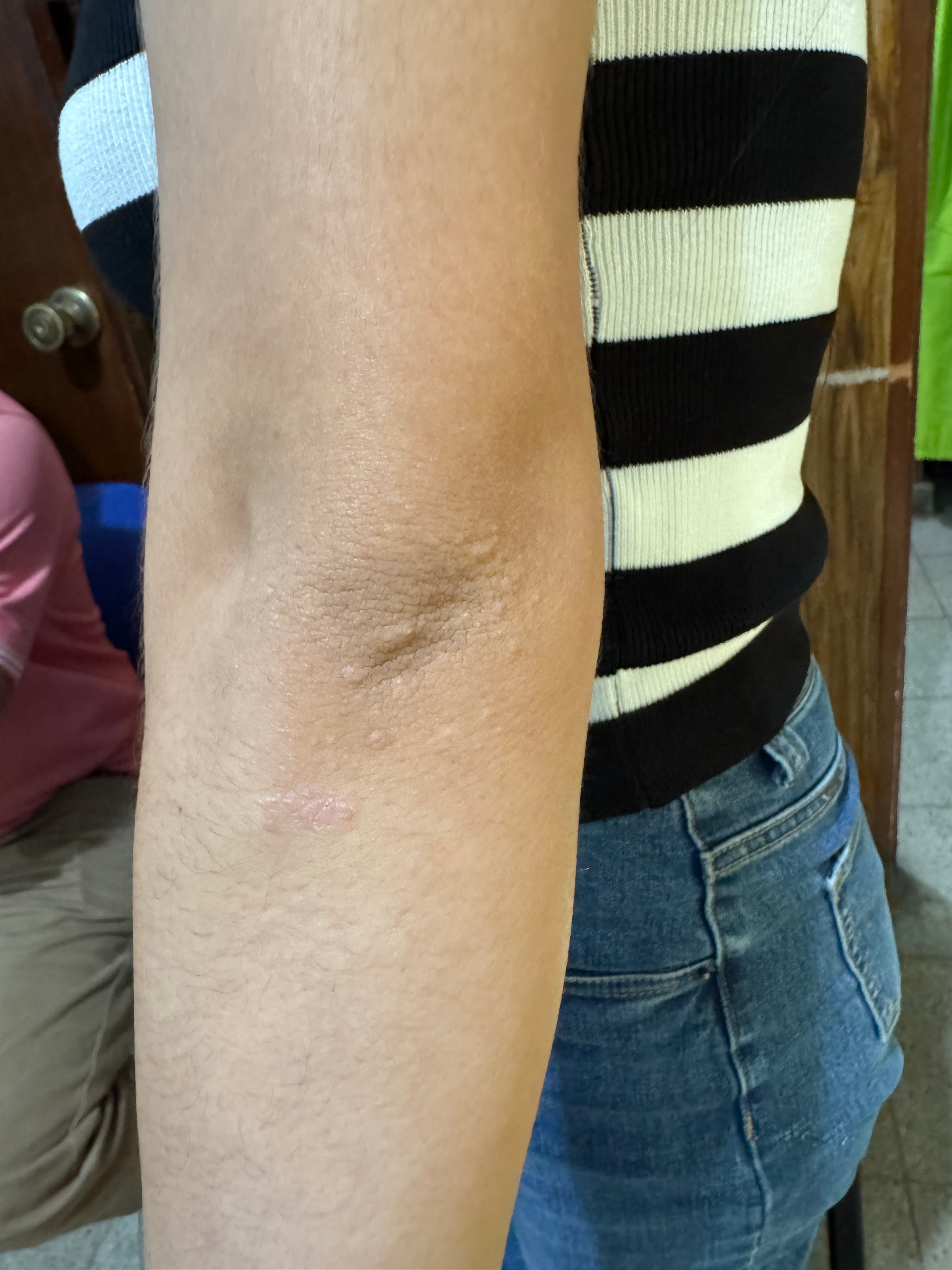 PSORIASIS en adolescente