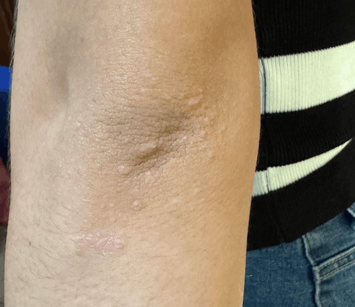 PSORIASIS en adolescente