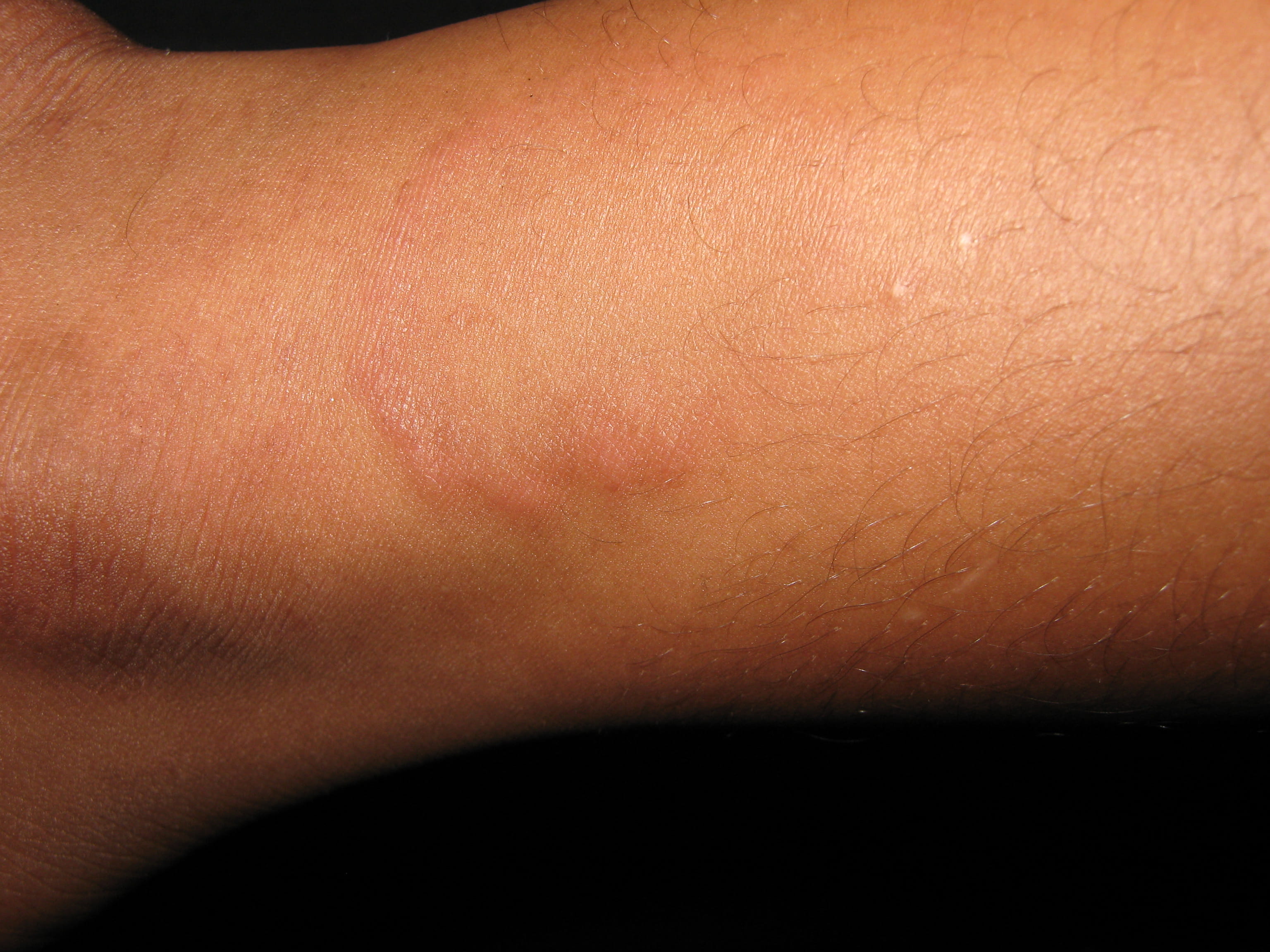 ERITEMA ANULAR