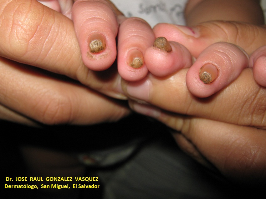 TINEA UNGUIM en niños
