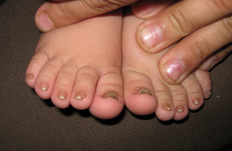 TINEA UNGUIM en niños