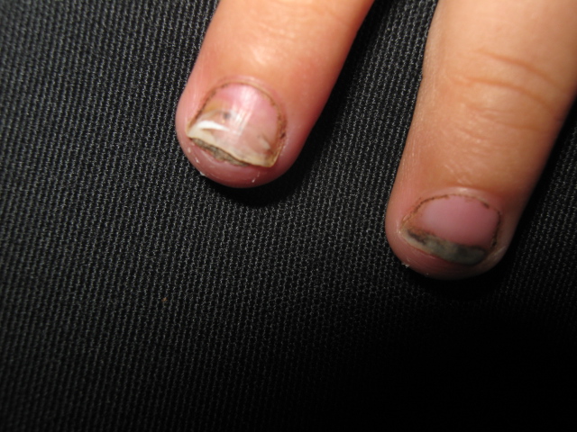 TINEA UNGUIM en niños