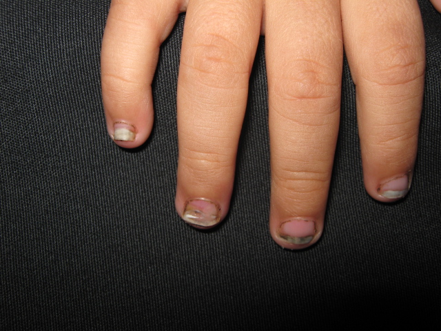 TINEA UNGUIM en niños