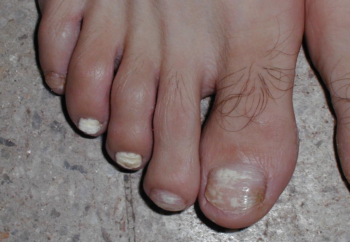 TINEA UNGUIM blanca superficial