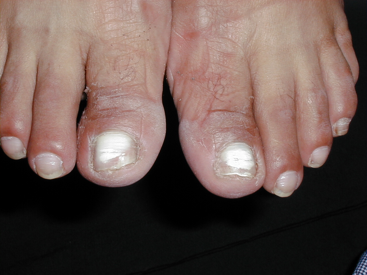 TINEA UNGUIM blanca superficial