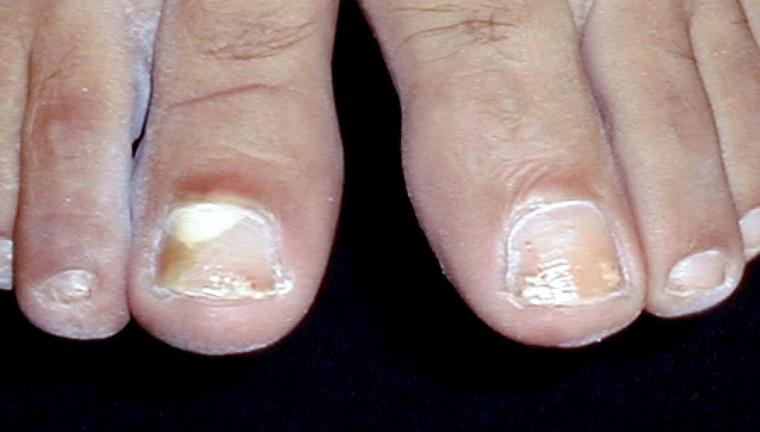 TINEA UNGUIM blanca superficial