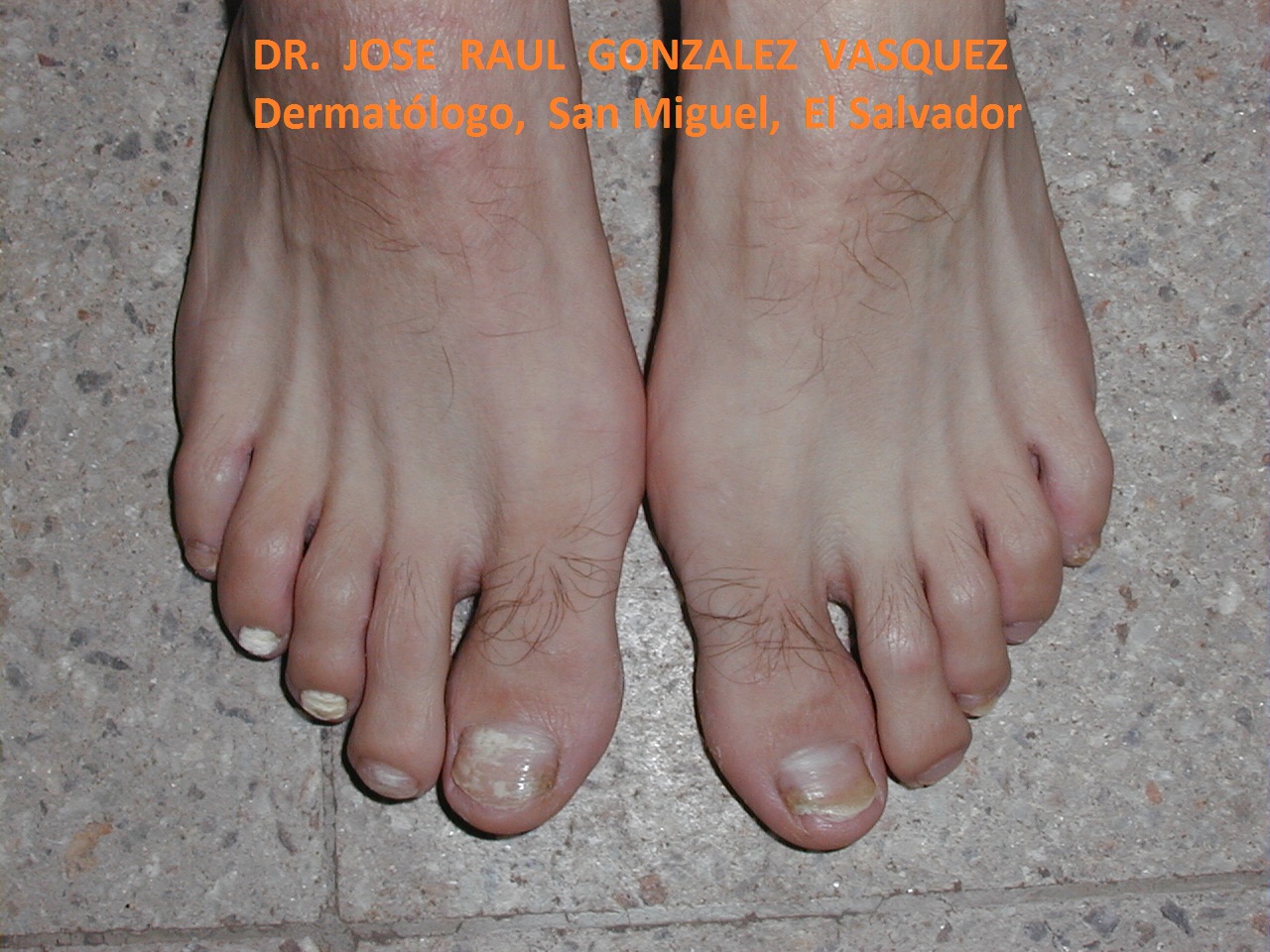 TINEA UNGUIM blanca superficial