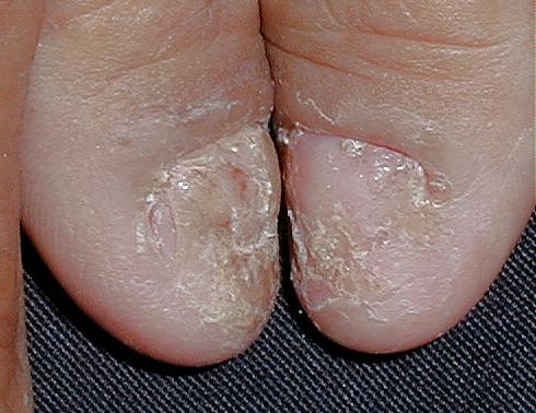 PSORIASIS DE LAS UÑAS
