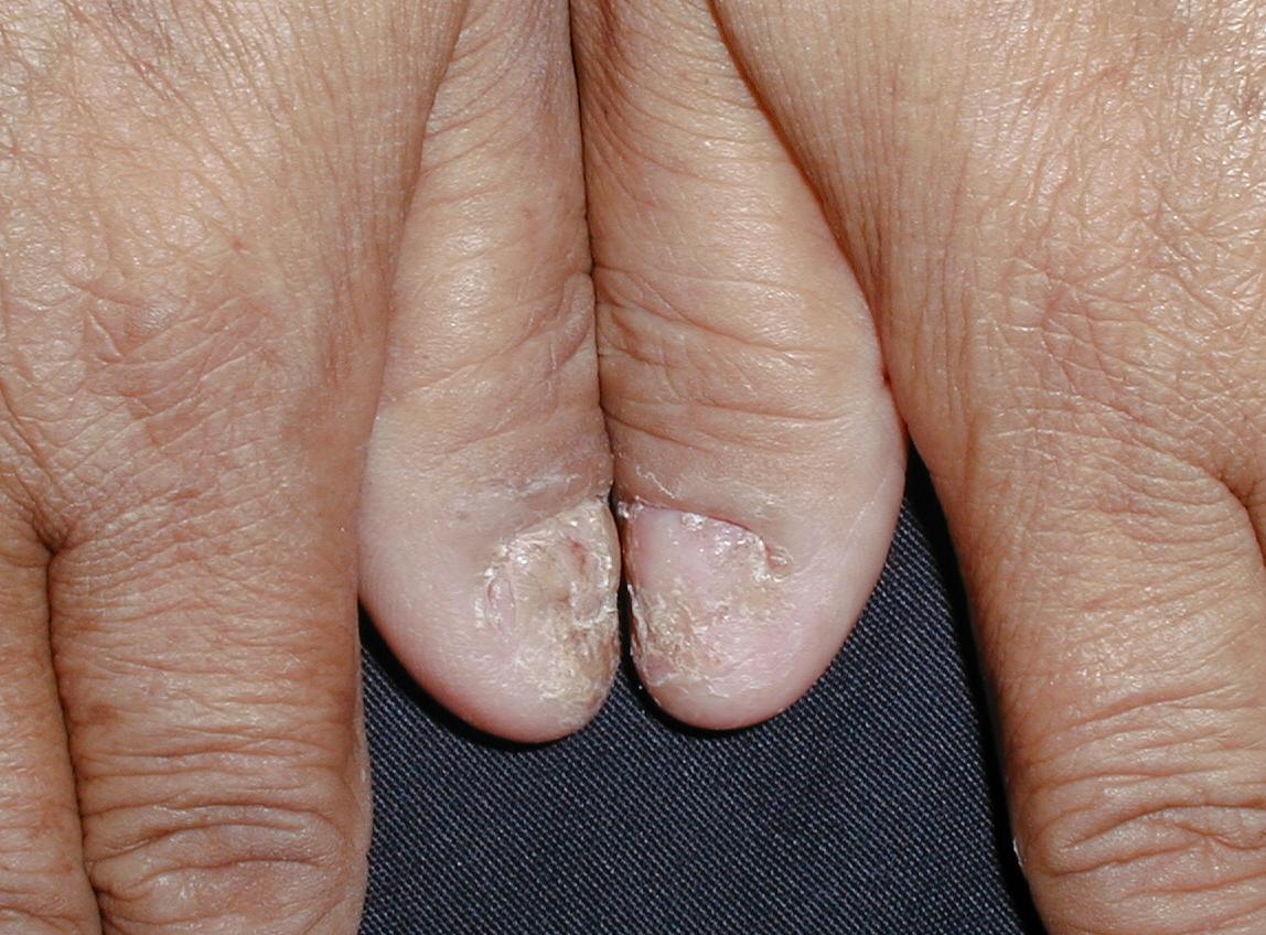 PSORIASIS DE LAS UÑAS